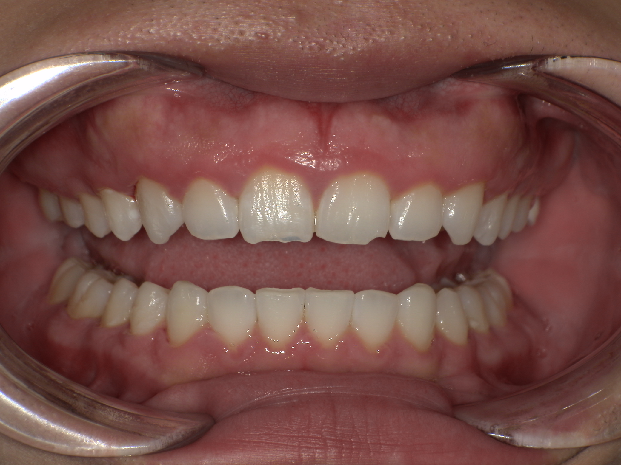 【治療後】口元下げたい、下の歯のすきっ歯気になる(男性/20代)の口元