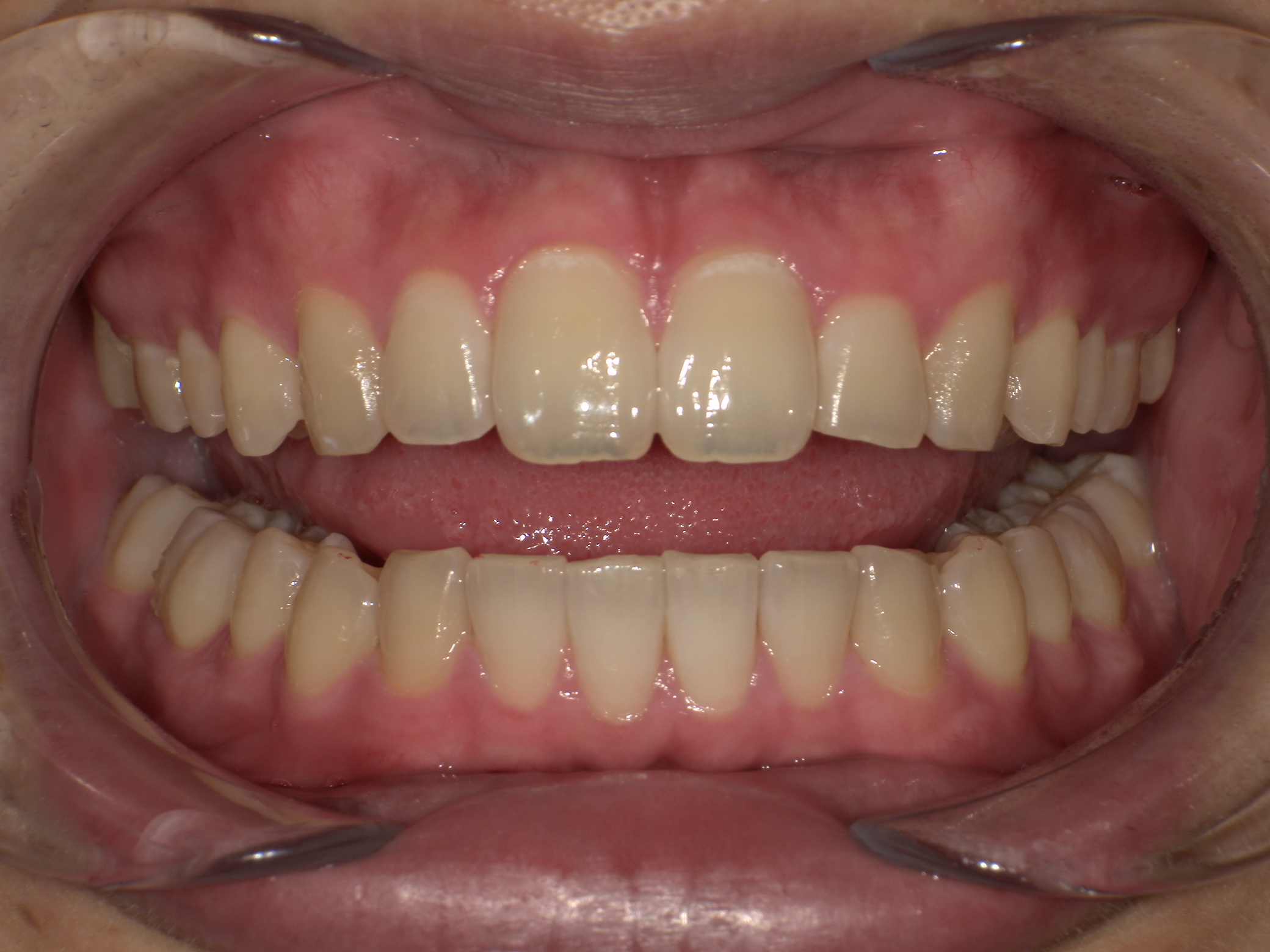 【治療後】歯並びがデコボコしている・上の歯が出ている・嚙み合わせが悪い(男性/20代)の口元