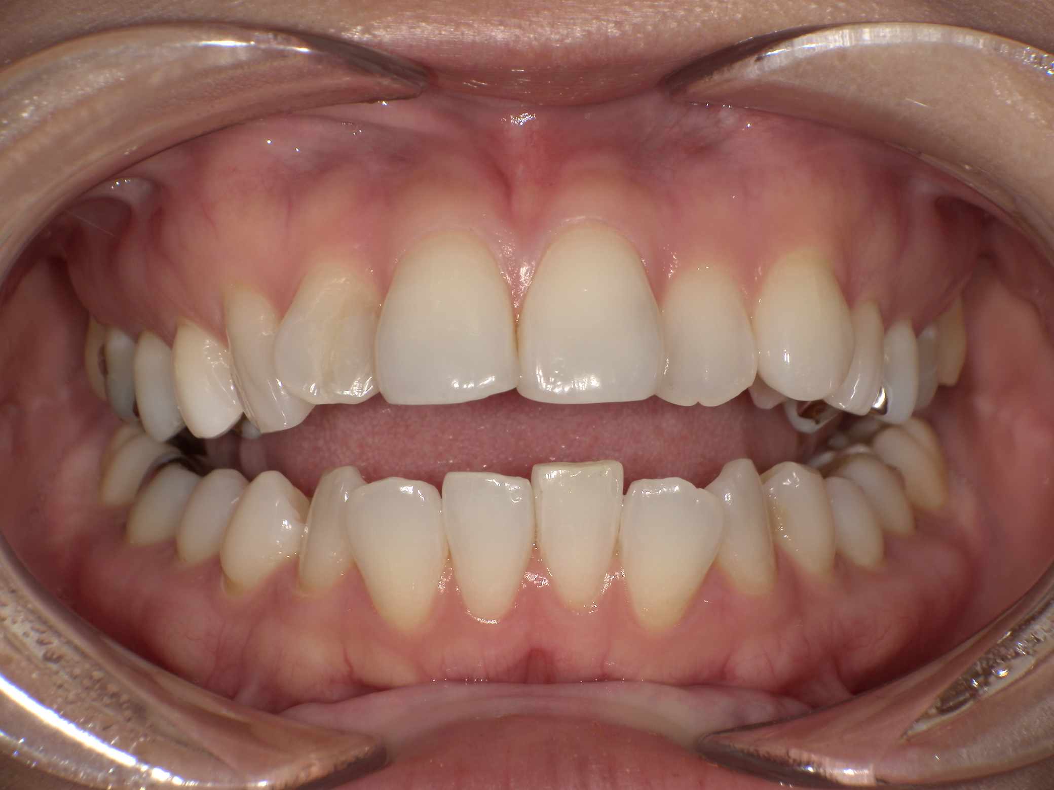 【治療前】上の歯が出ている・口元が出ているのが気になる(女性/30代)の口元