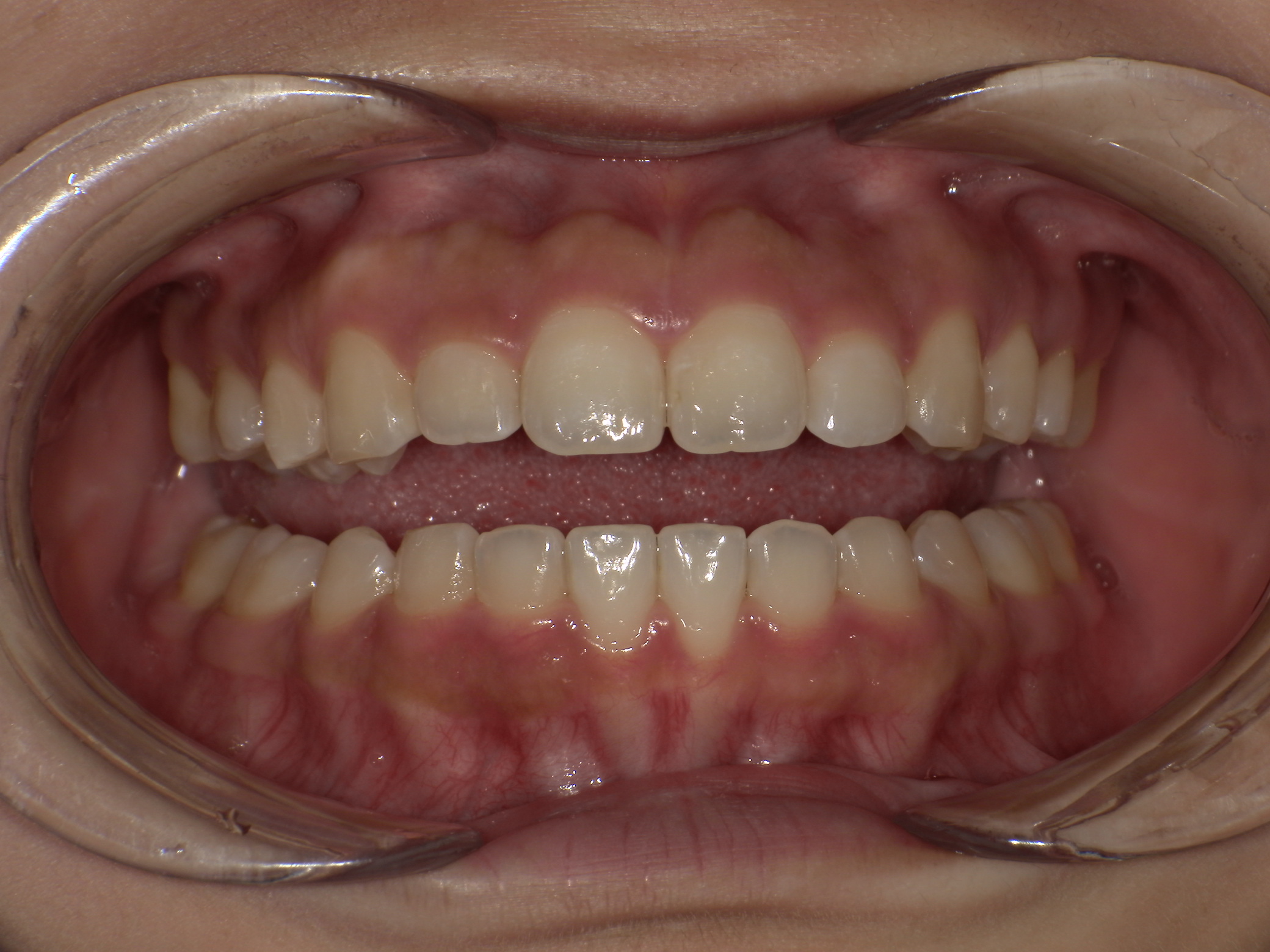 【治療後】上の歯が出ている・嚙み合わせが悪い(女性/20代)の口元