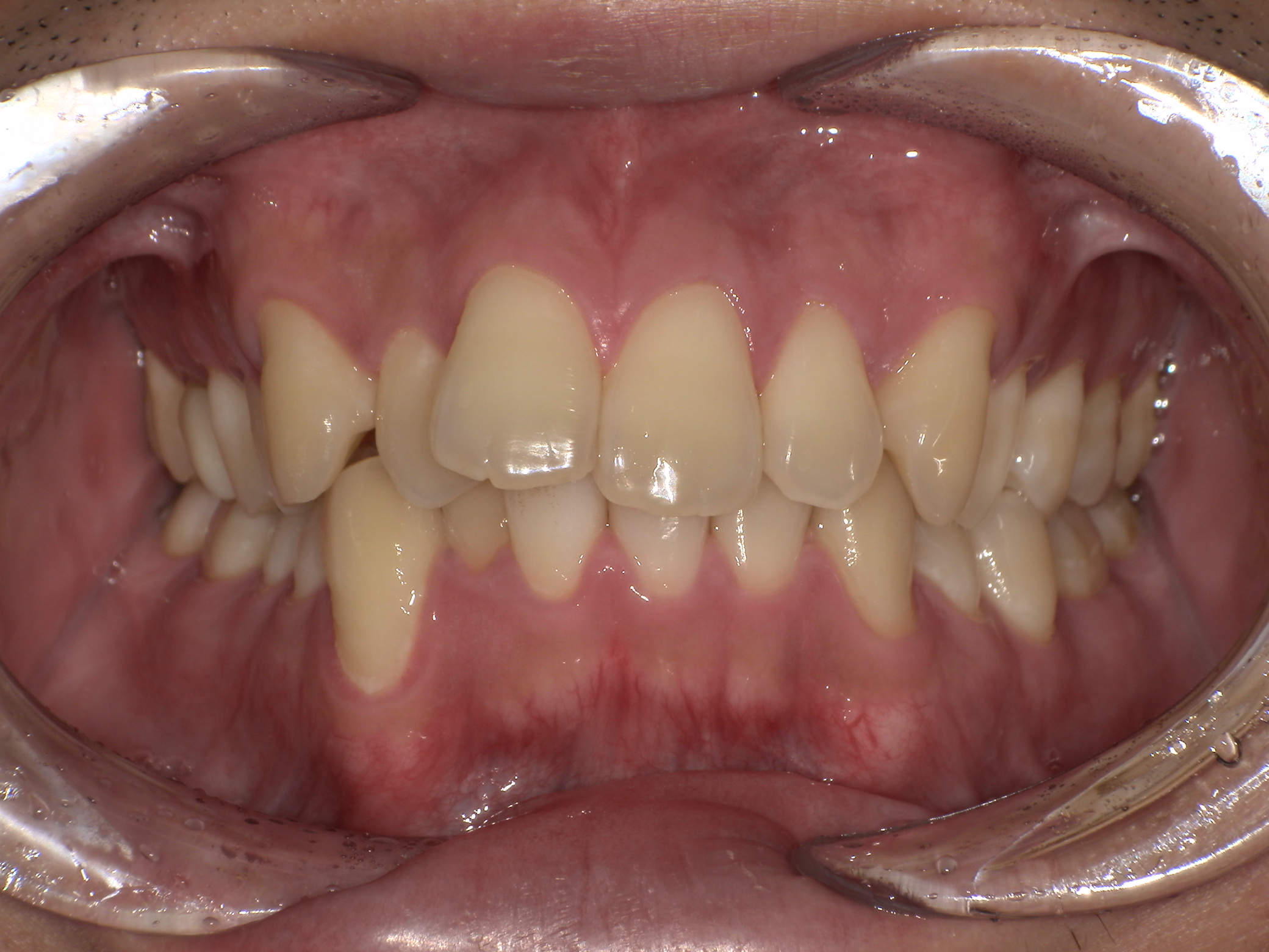 【治療前】歯並びがデコボコしている(男性/20代)の口元