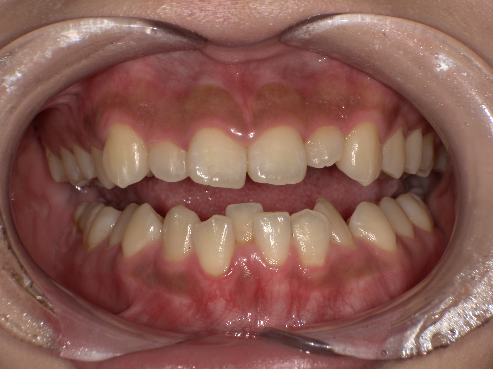 【治療前】前歯のがたつきが気になる(女性/20代)の口元