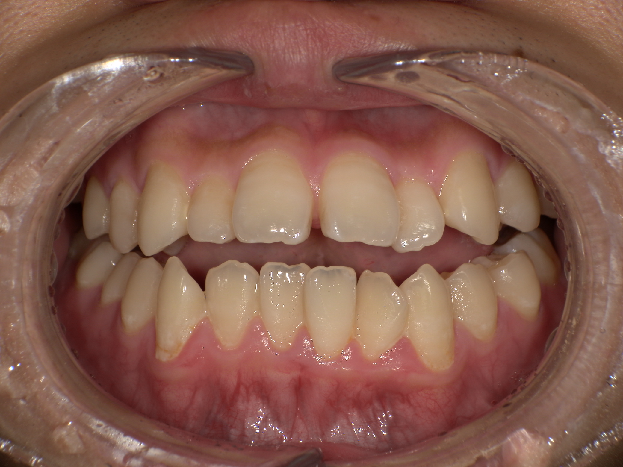 【治療前】歯並びがデコボコしている(男性/20代)の口元