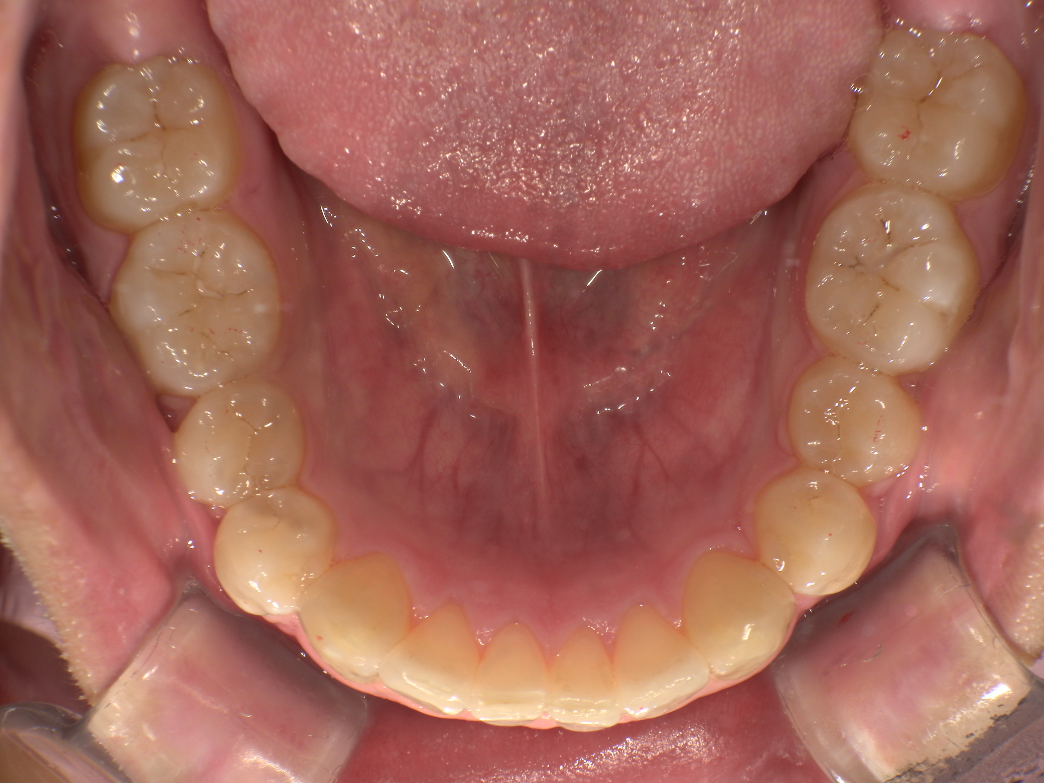 【治療後】下の歯のがたつきが気になる(男性/10代)の口元