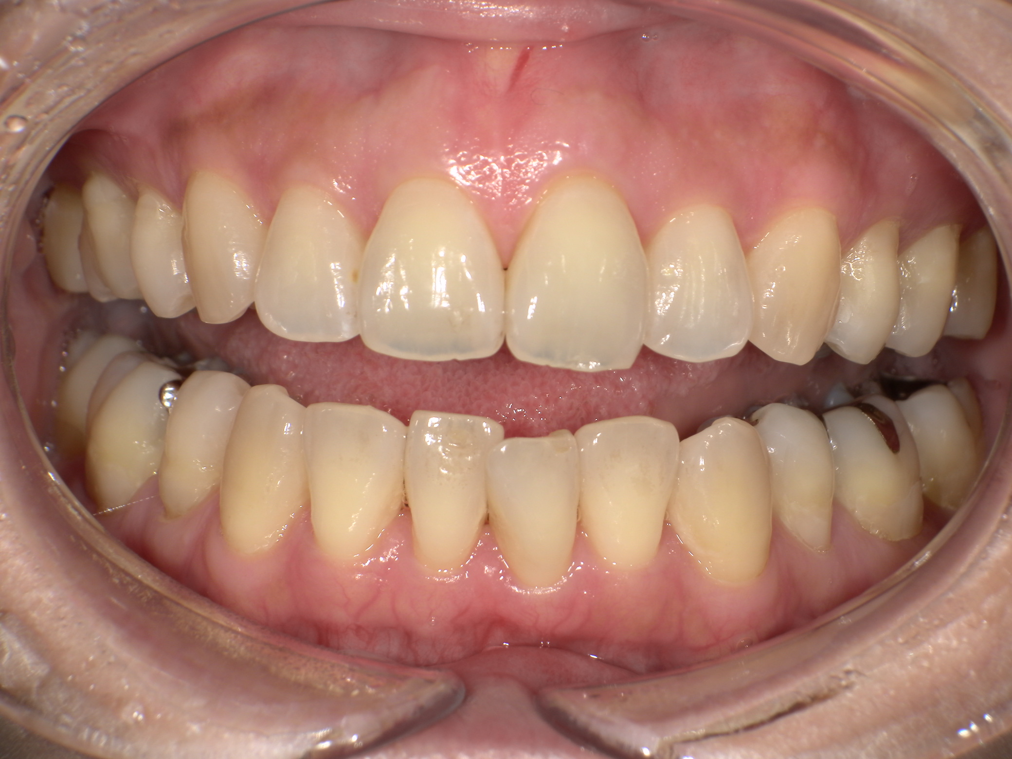 【治療前】歯並びがデコボコしている(女性/40代)の口元