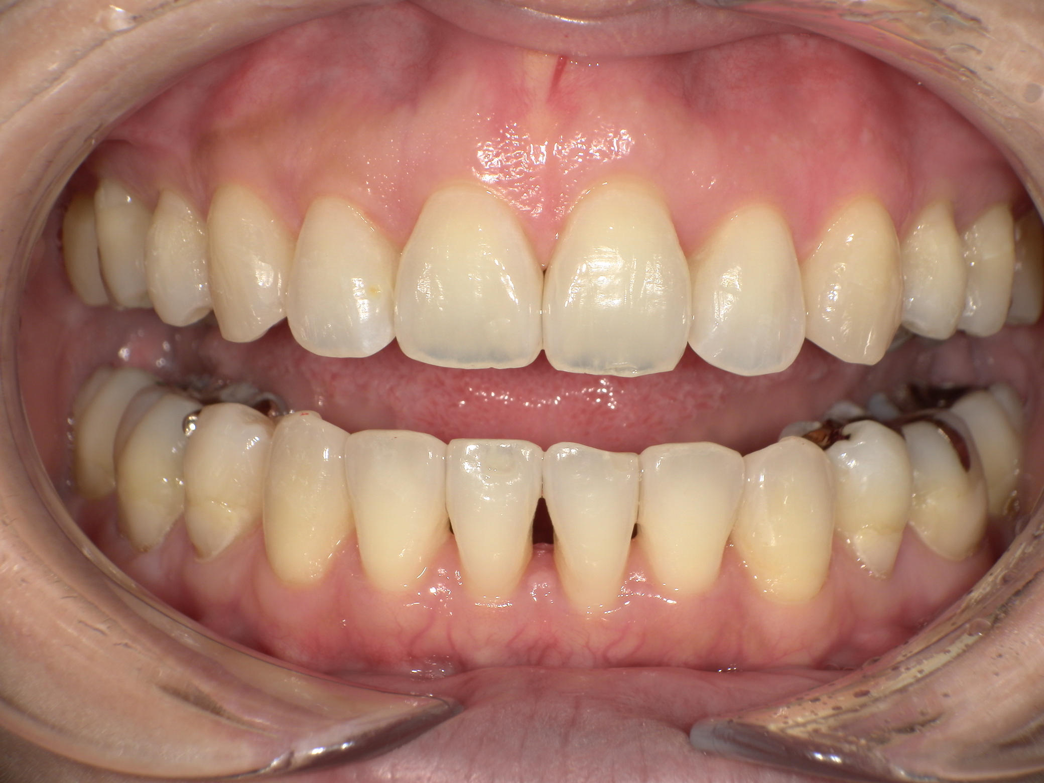 【治療後】歯並びがデコボコしている(女性/40代)の口元