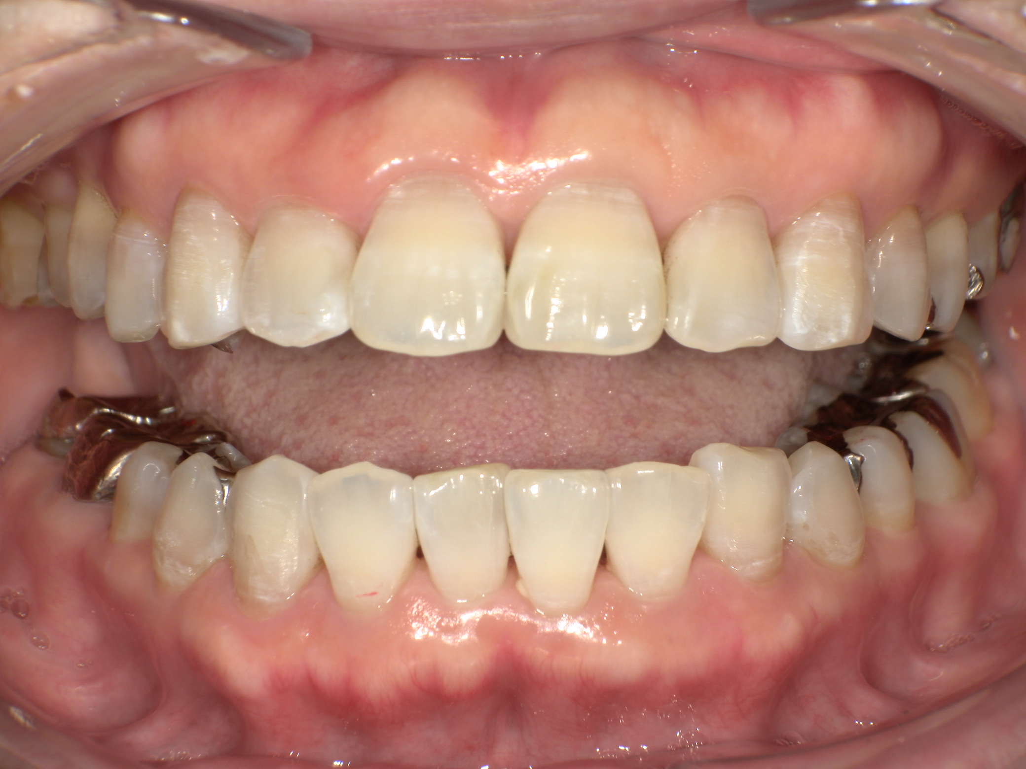 【治療後】上の歯が出ている(女性/50代)の口元