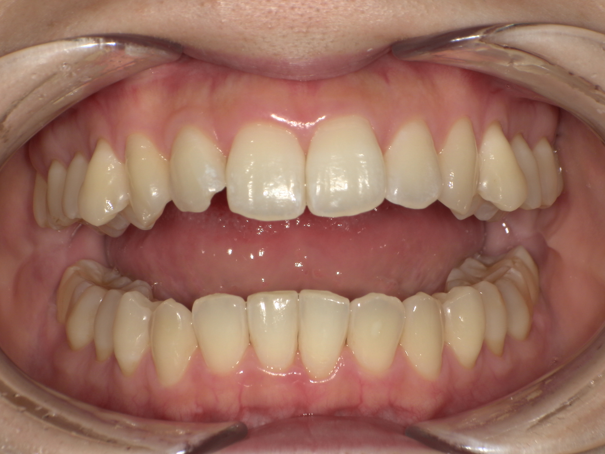 【治療前】前歯の中心のずれ・嚙み合わせが悪い(女性/20代)の口元