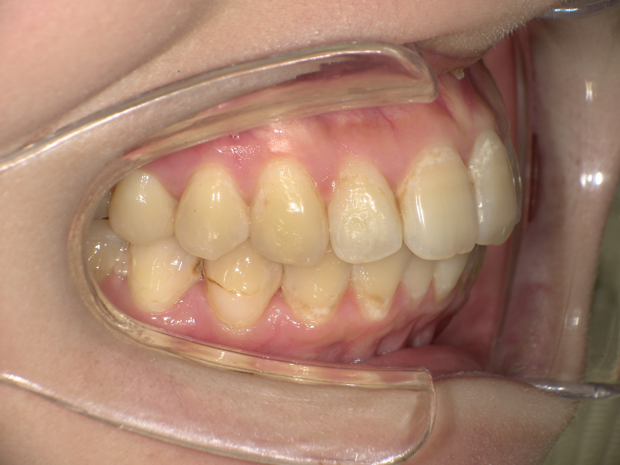 【治療後】歯並びがデコボコしている・上の歯がでている(女性/30代)の口元