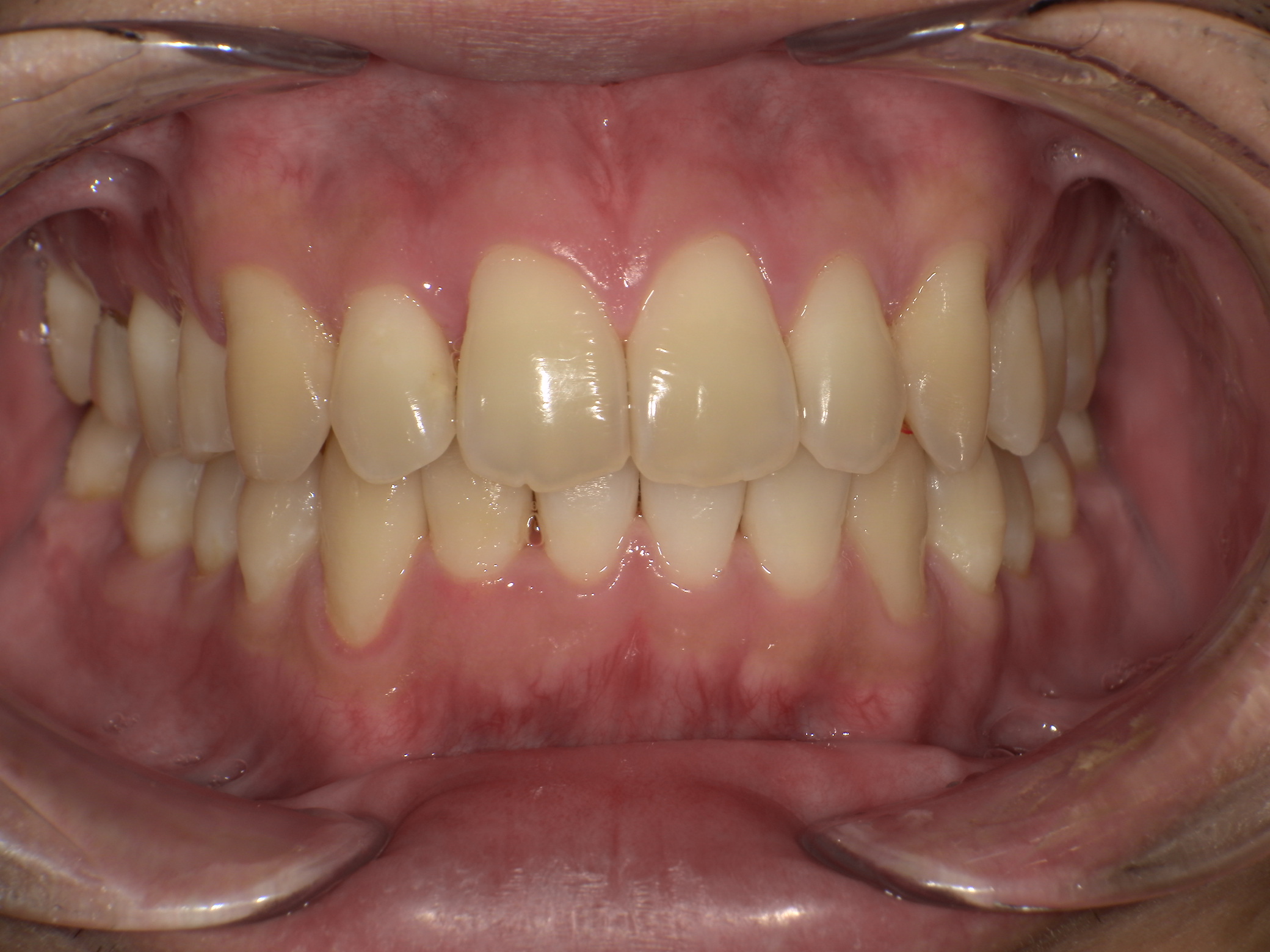 【治療後】歯並びがデコボコしている(男性/20代)の口元