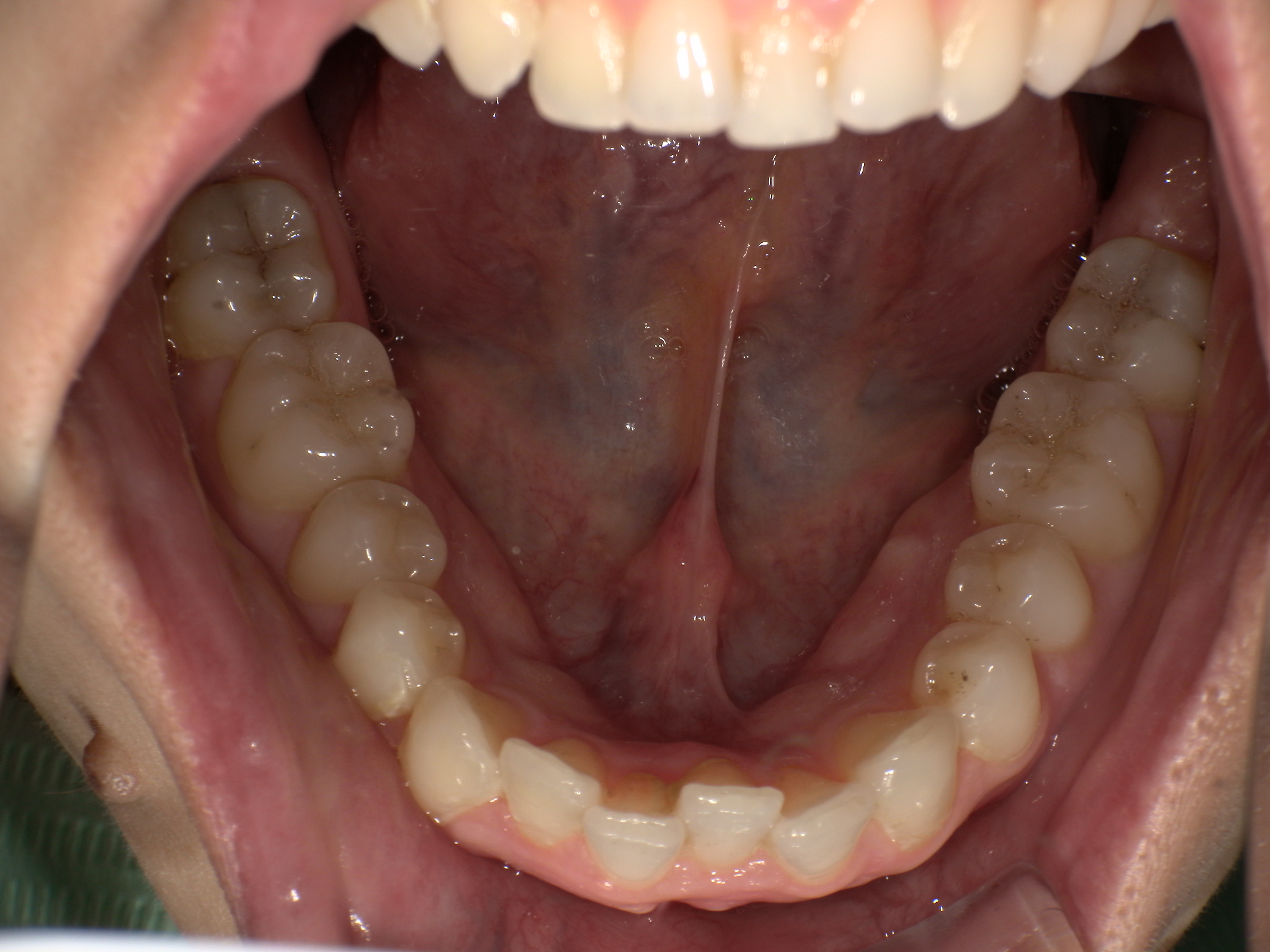 【治療前】４年前マウスピース矯正した時の後戻り(女性/30代)の口元