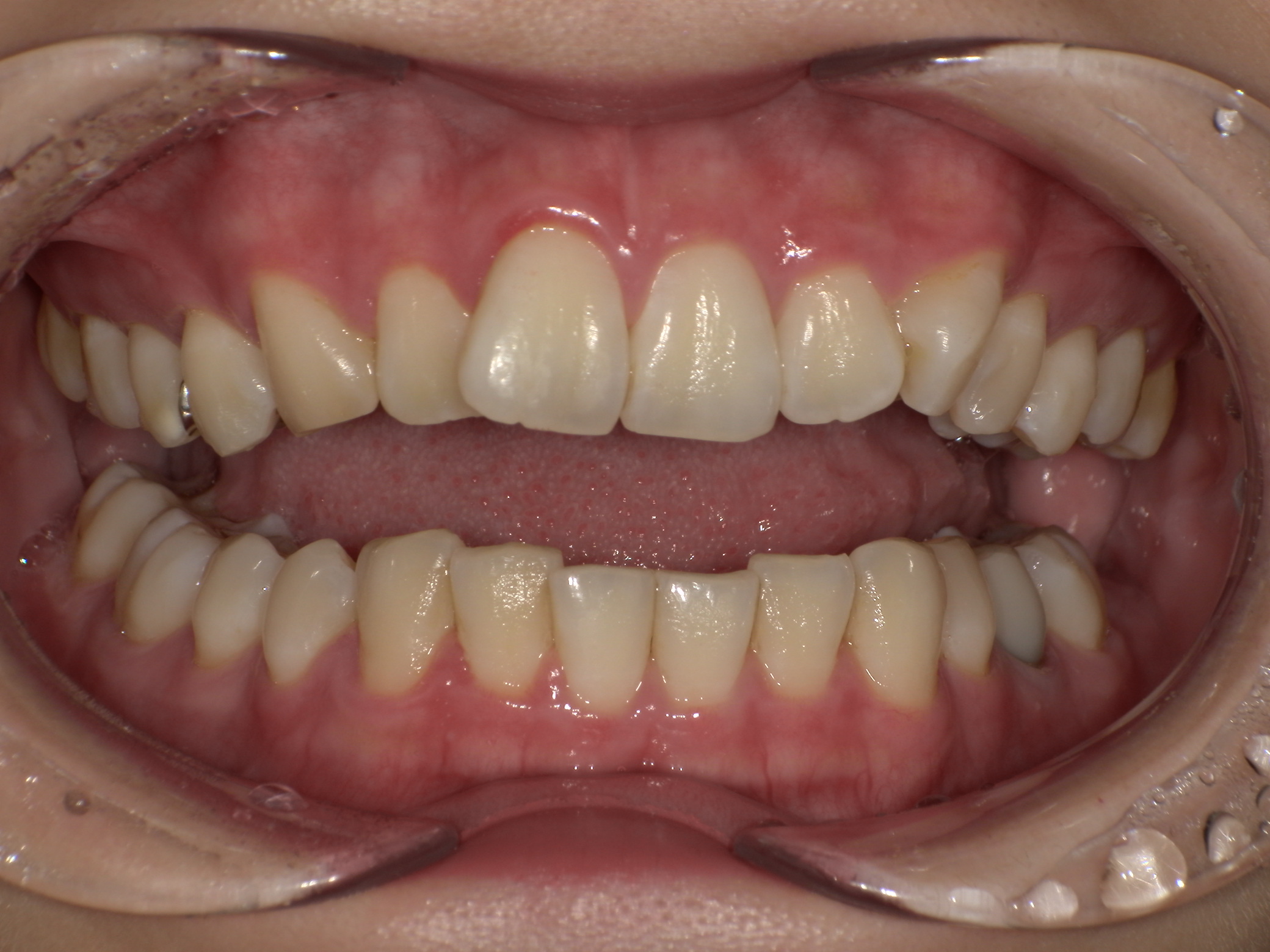 【治療前】前歯のガタガタが気になる(女性/20代)の口元