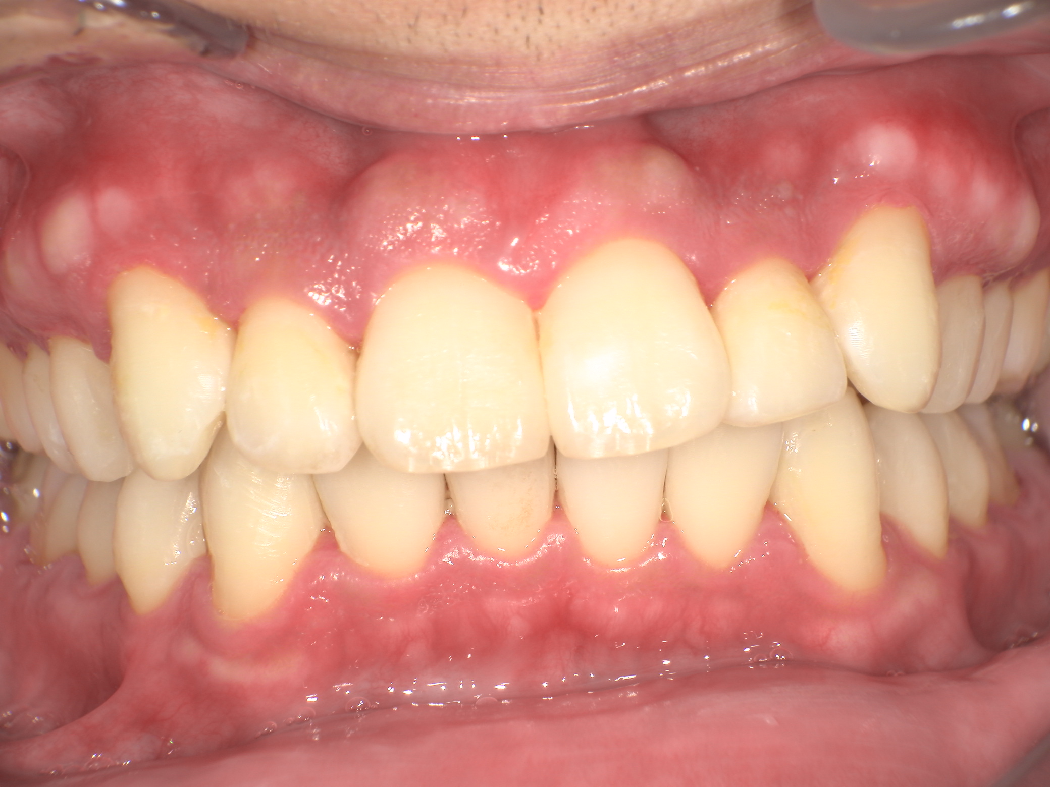 【治療後】歯並びがデコボコしている・上の歯が出ている・嚙み合わせが悪い(男性/20代)の口元