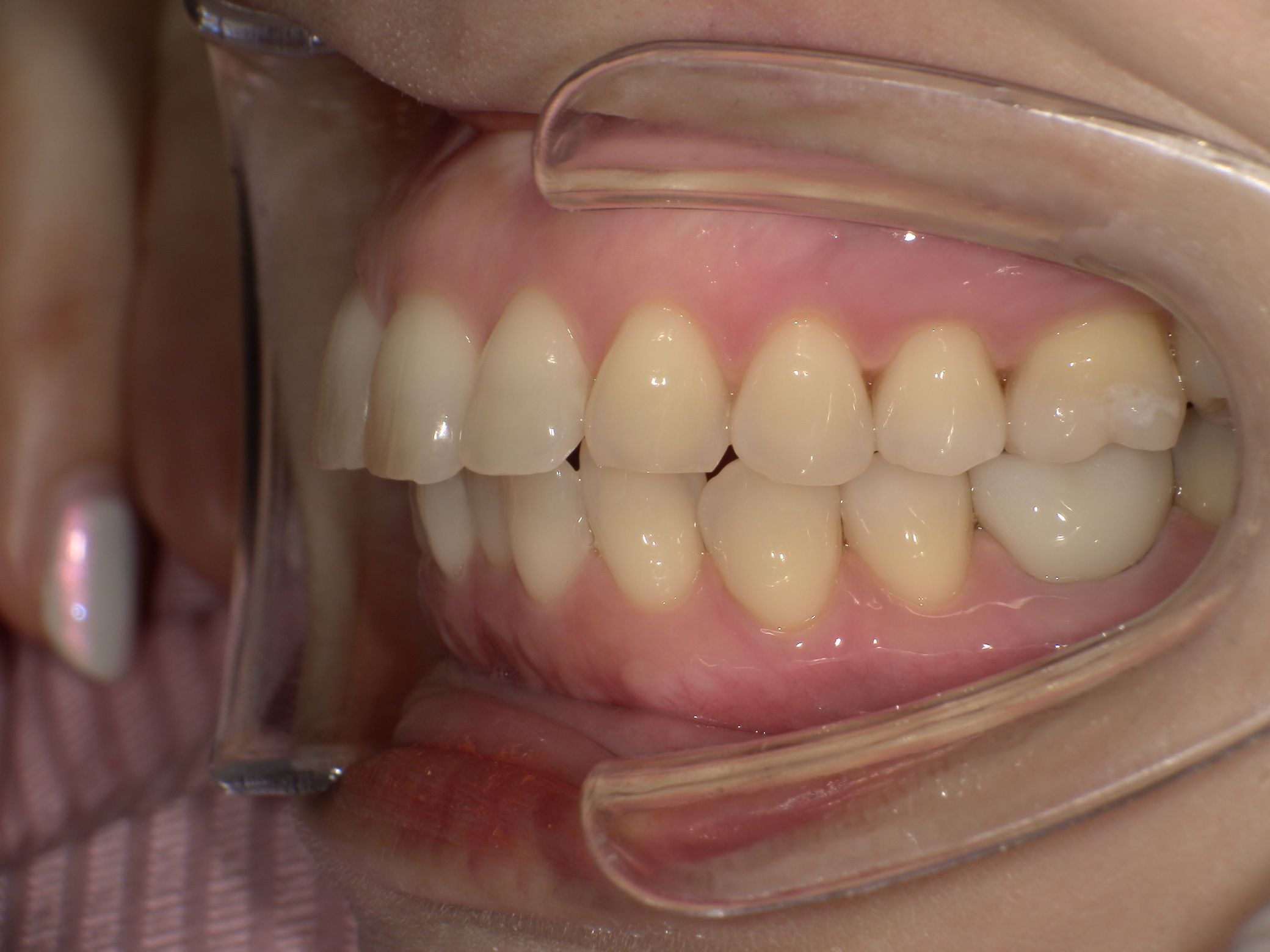 【治療前】上の歯が出ている(女性/40代)の口元