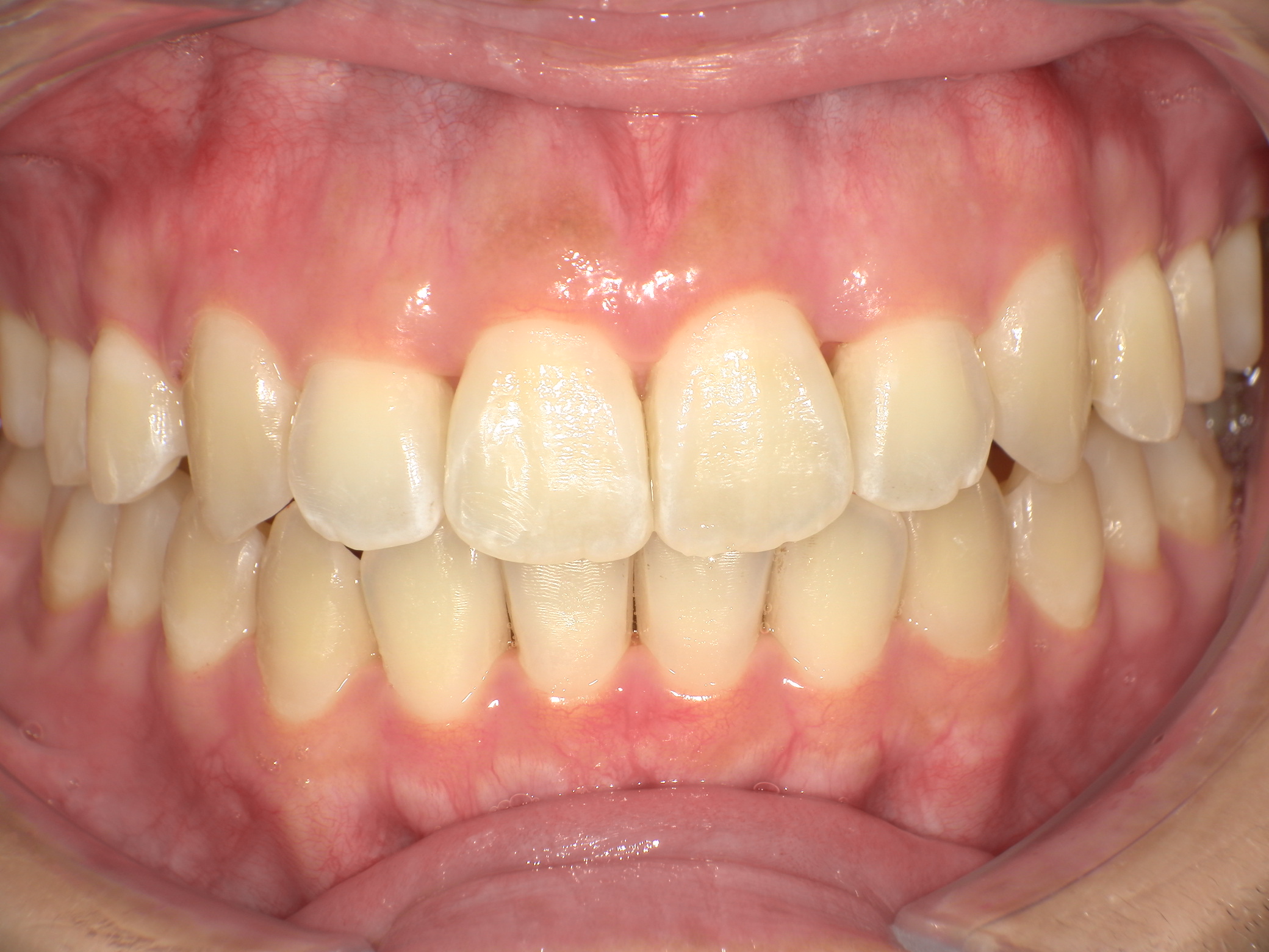 【治療後】歯並びがデコボコしている・上の歯が出ている・笑った時の歯と歯茎の見え方(女性/20代)の口元