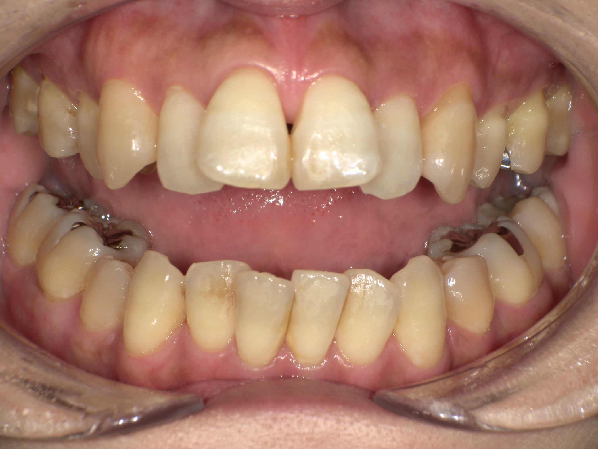 【治療前】歯並びがデコボコしている(女性/50代)の口元