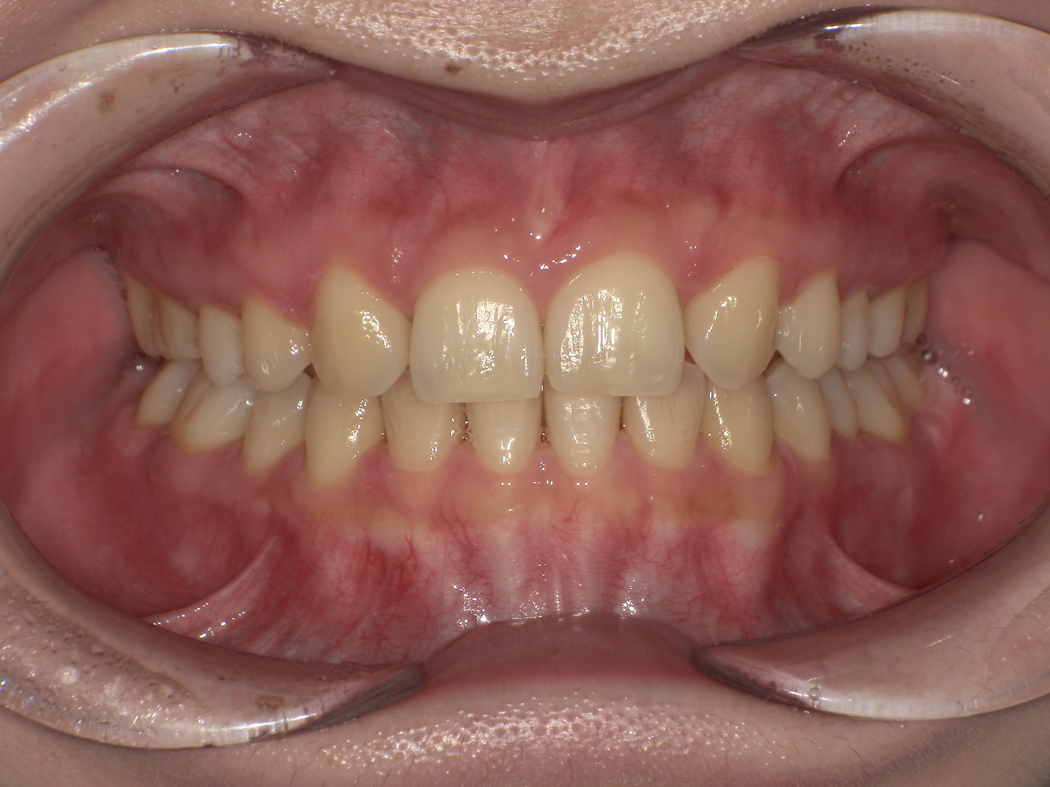 【治療後】10年前ワイヤー矯正していたが後戻りしてしまって、すきっ歯が気になる(女性/30代)の口元