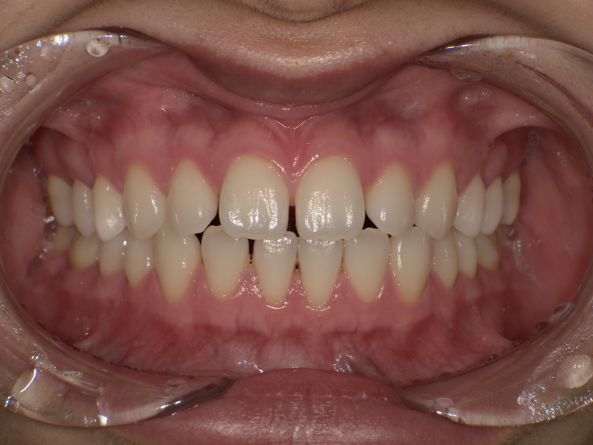 【治療前】すきっ歯気になる(女性/20代)の口元