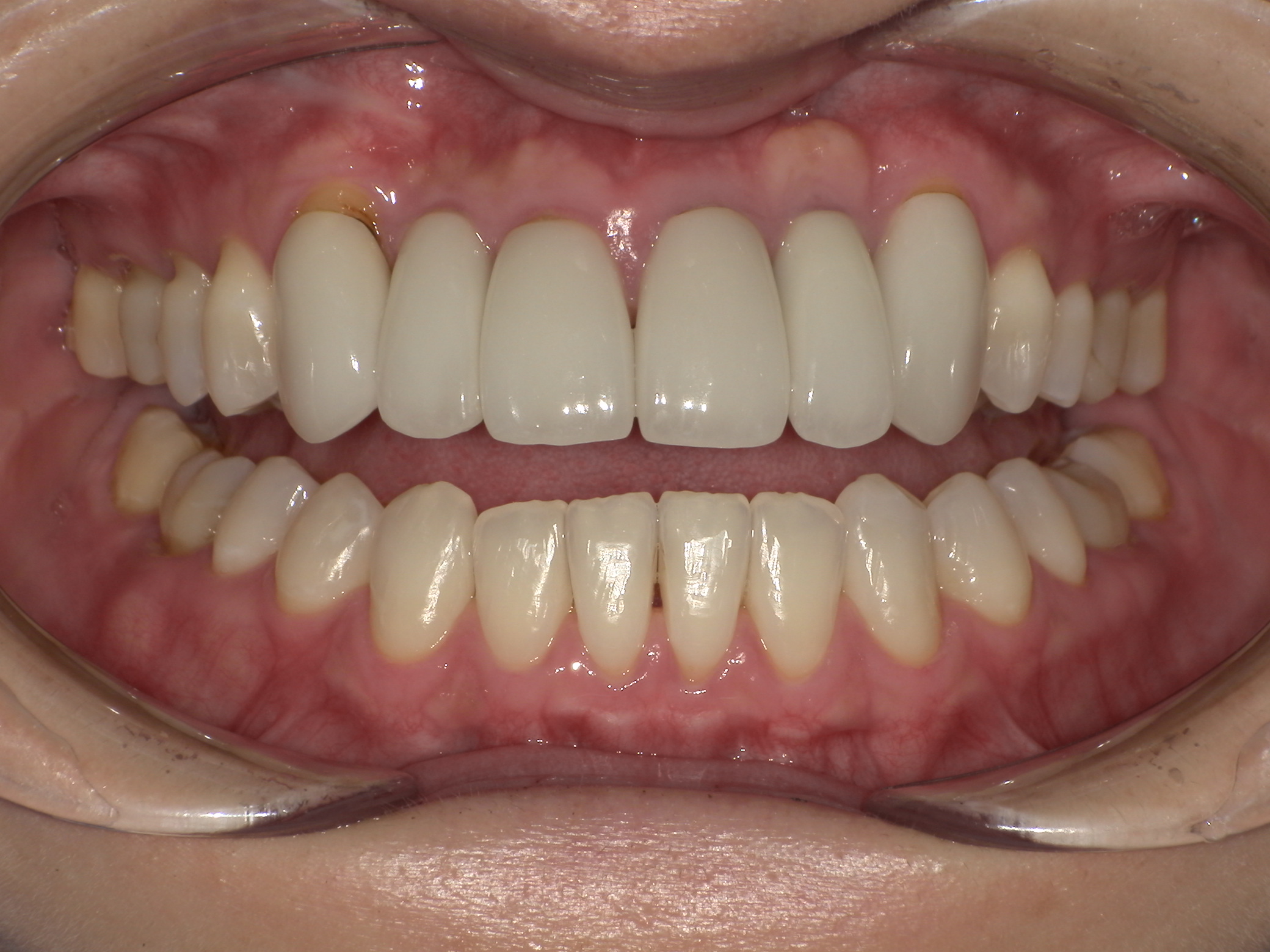 【治療後】下の歯の歯並びが気になる(女性/40代)の口元