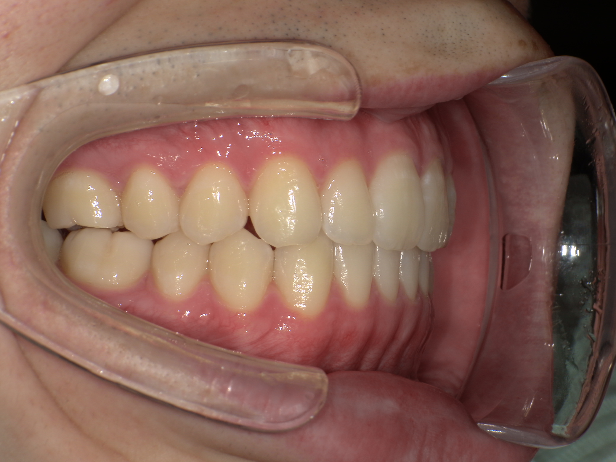 【治療後】口元が出ているのが気になる(男性/20代)の口元