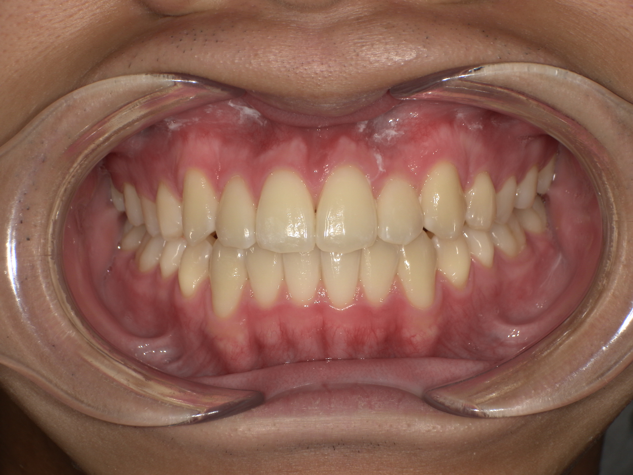 【治療後】前歯のガタガタが気になる(男性/10代)の口元