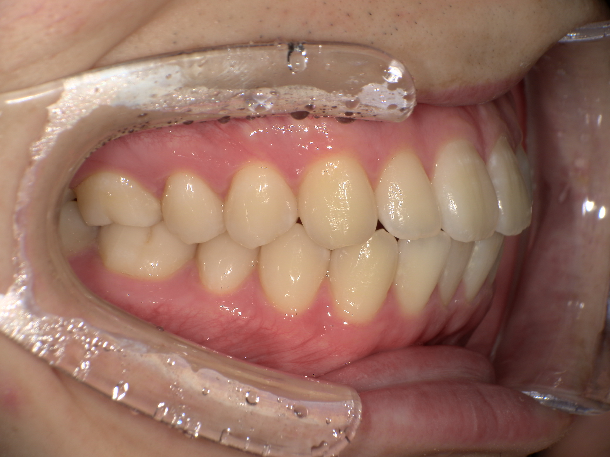 【治療前】口元が出ているのが気になる(男性/20代)の口元