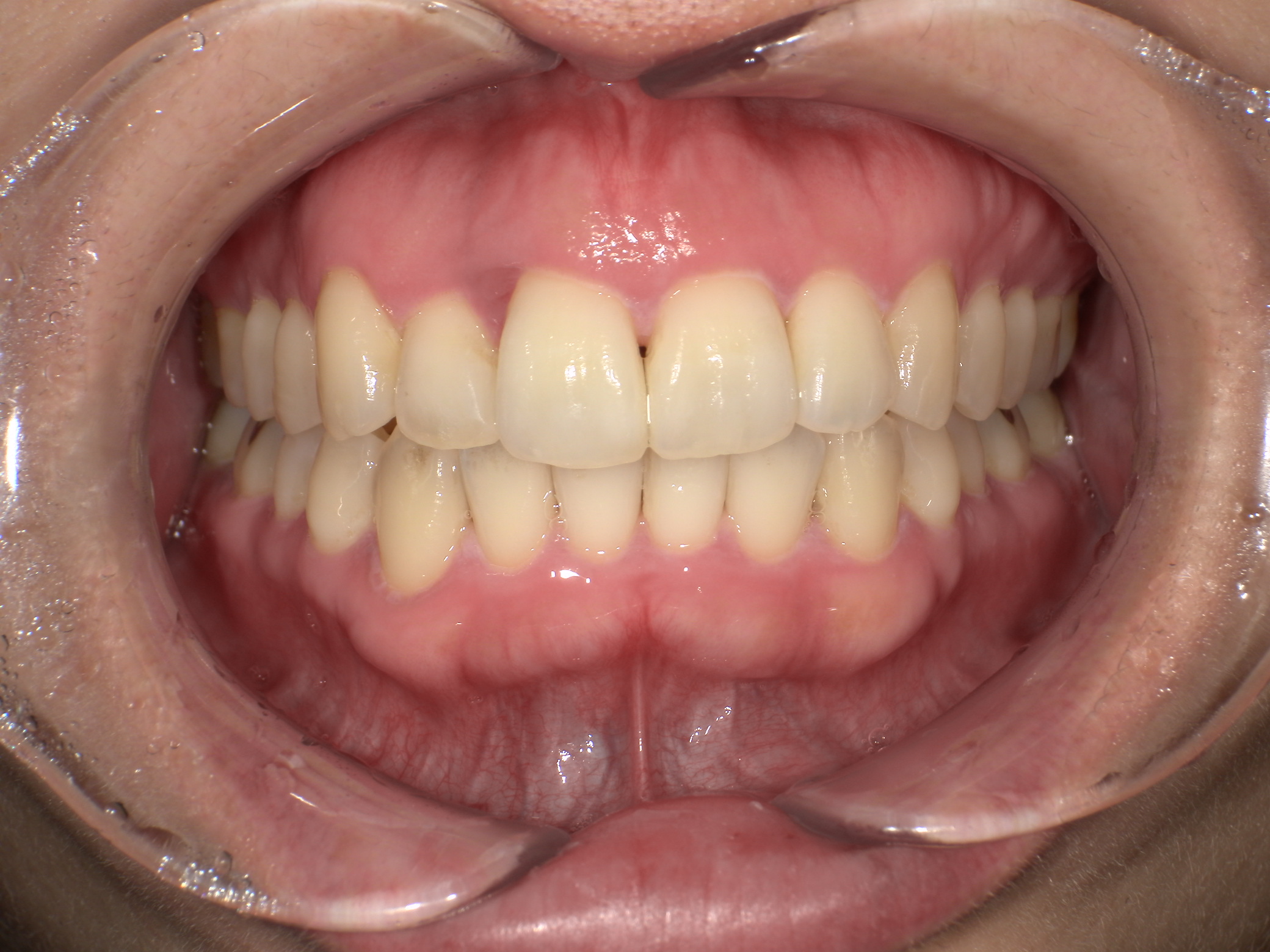 【治療後】歯並びがデコボコしている(女性/40代)の口元