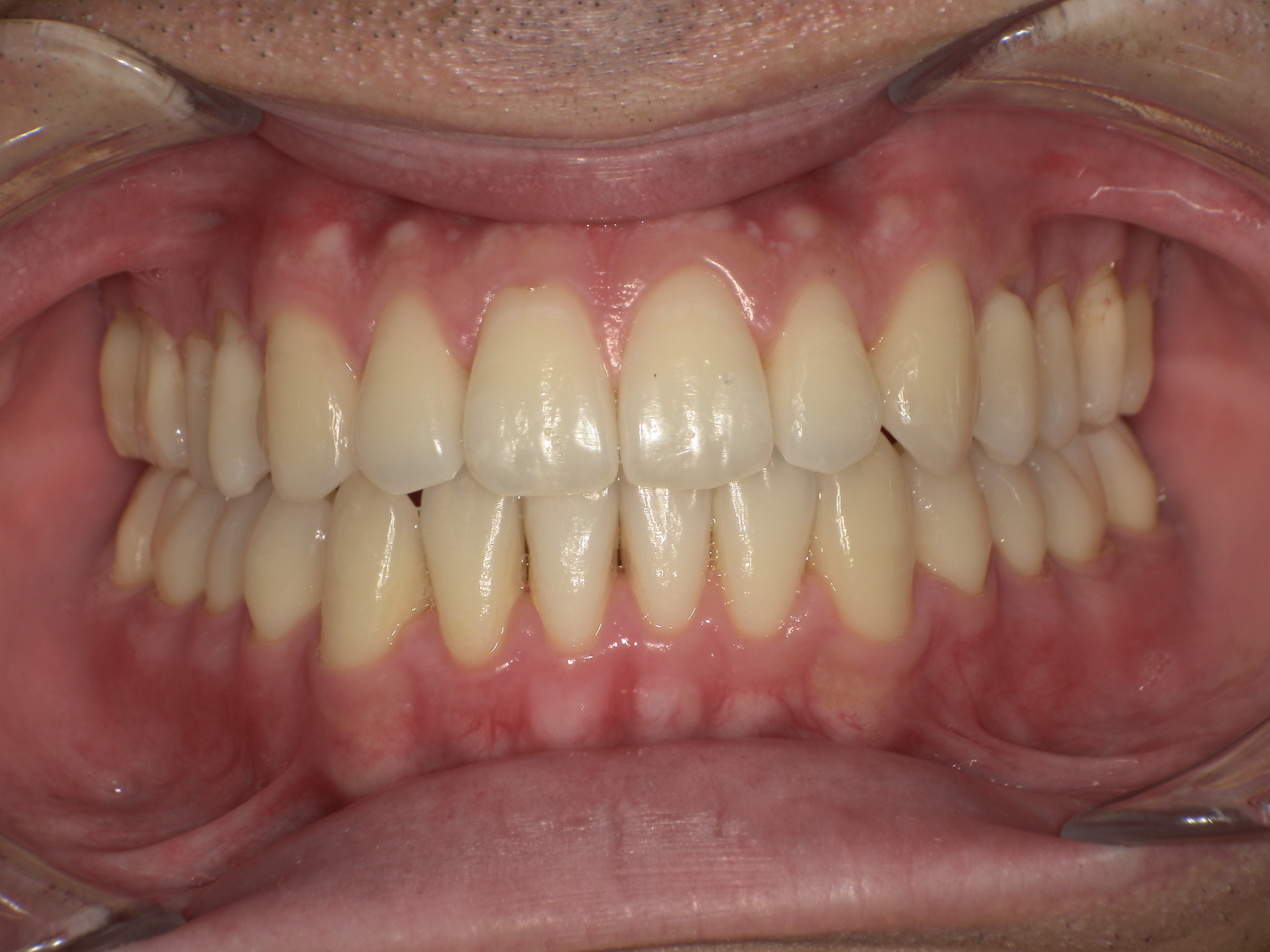 【治療後】前歯の中心のずれが気になる(男性/20代)の口元