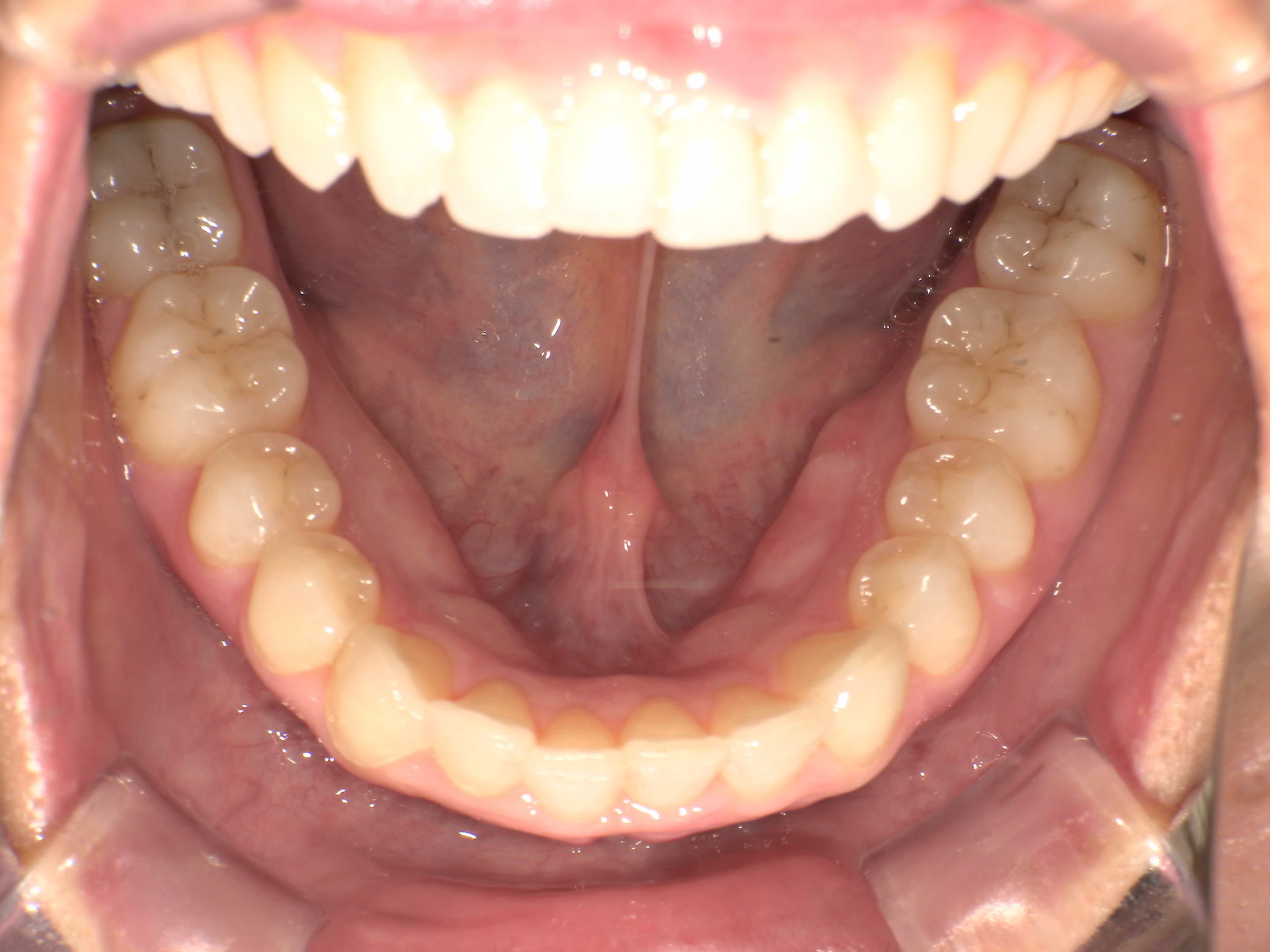 【治療後】４年前マウスピース矯正した時の後戻り(女性/30代)の口元
