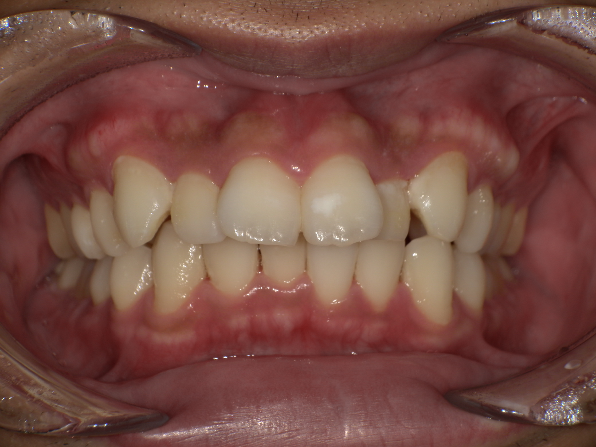 【治療前】歯並びがデコボコしている・上の歯が出ている・嚙み合わせが悪い(男性/20代)の口元