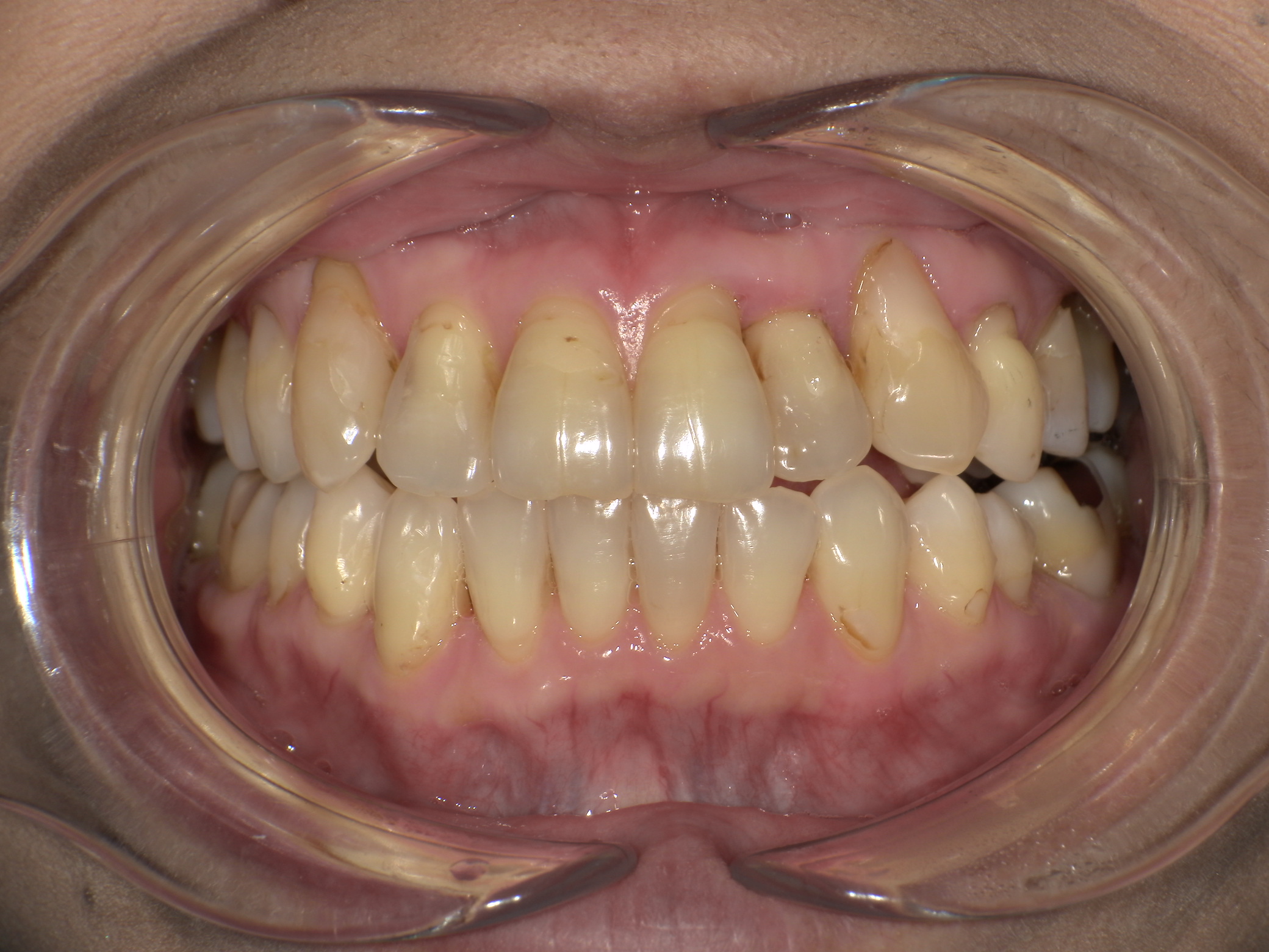 【治療後】前歯のがたつきが気になる(女性/50代)の口元