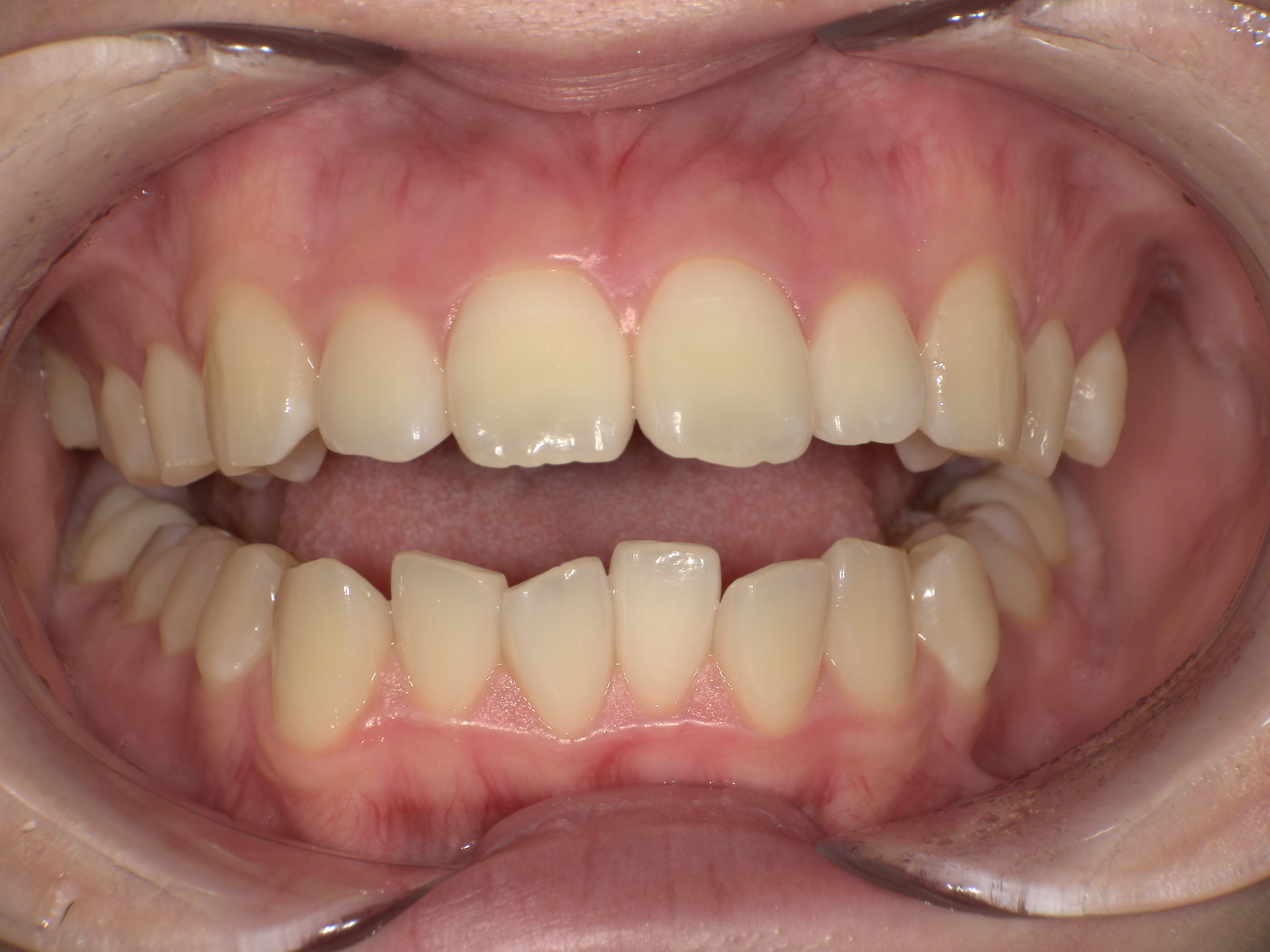 【治療前】歯並びがデコボコしている・上の歯が出ている(女性/20代)の口元