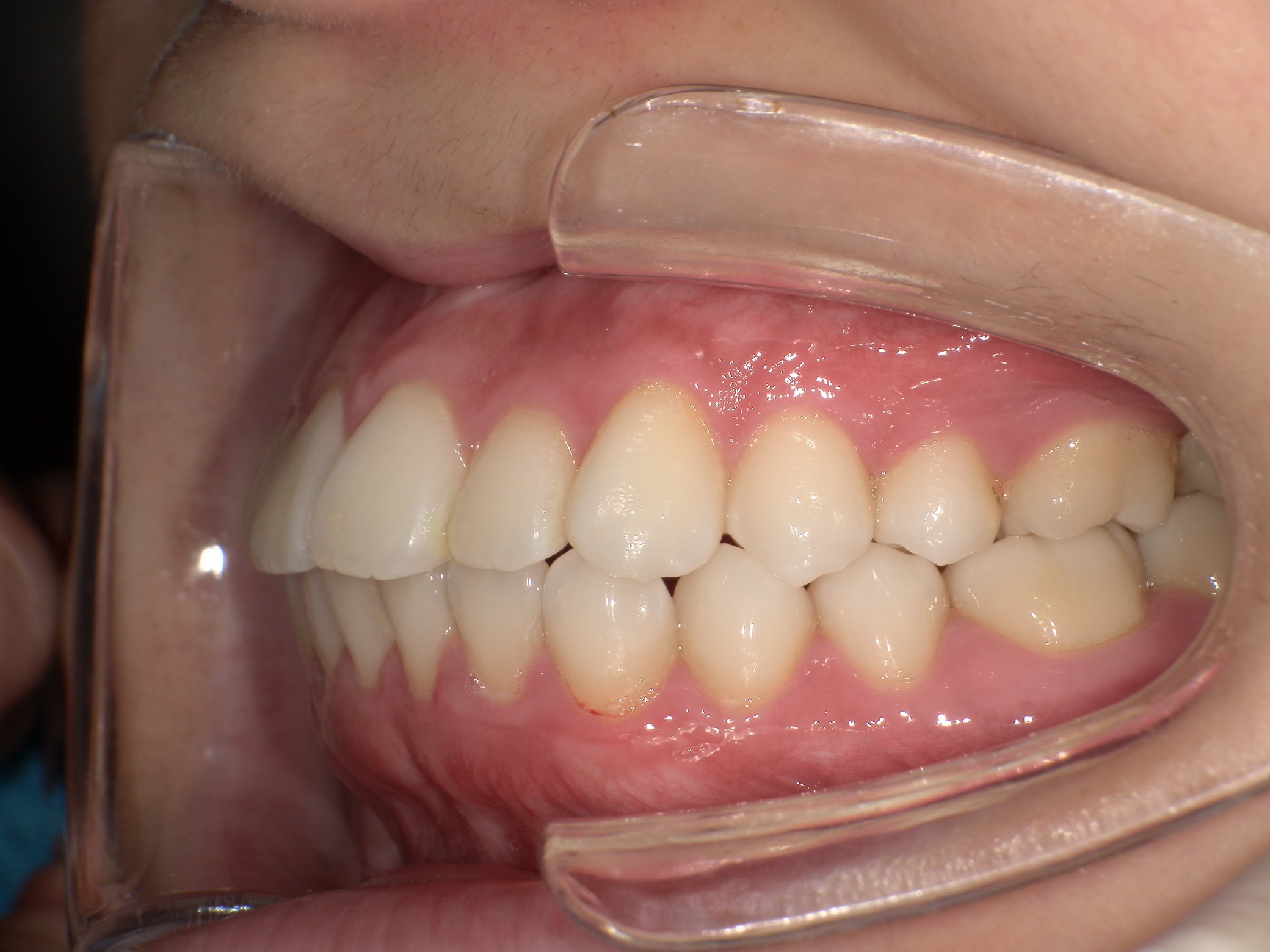 【治療前】上の歯が出ている(女性/20代)の口元