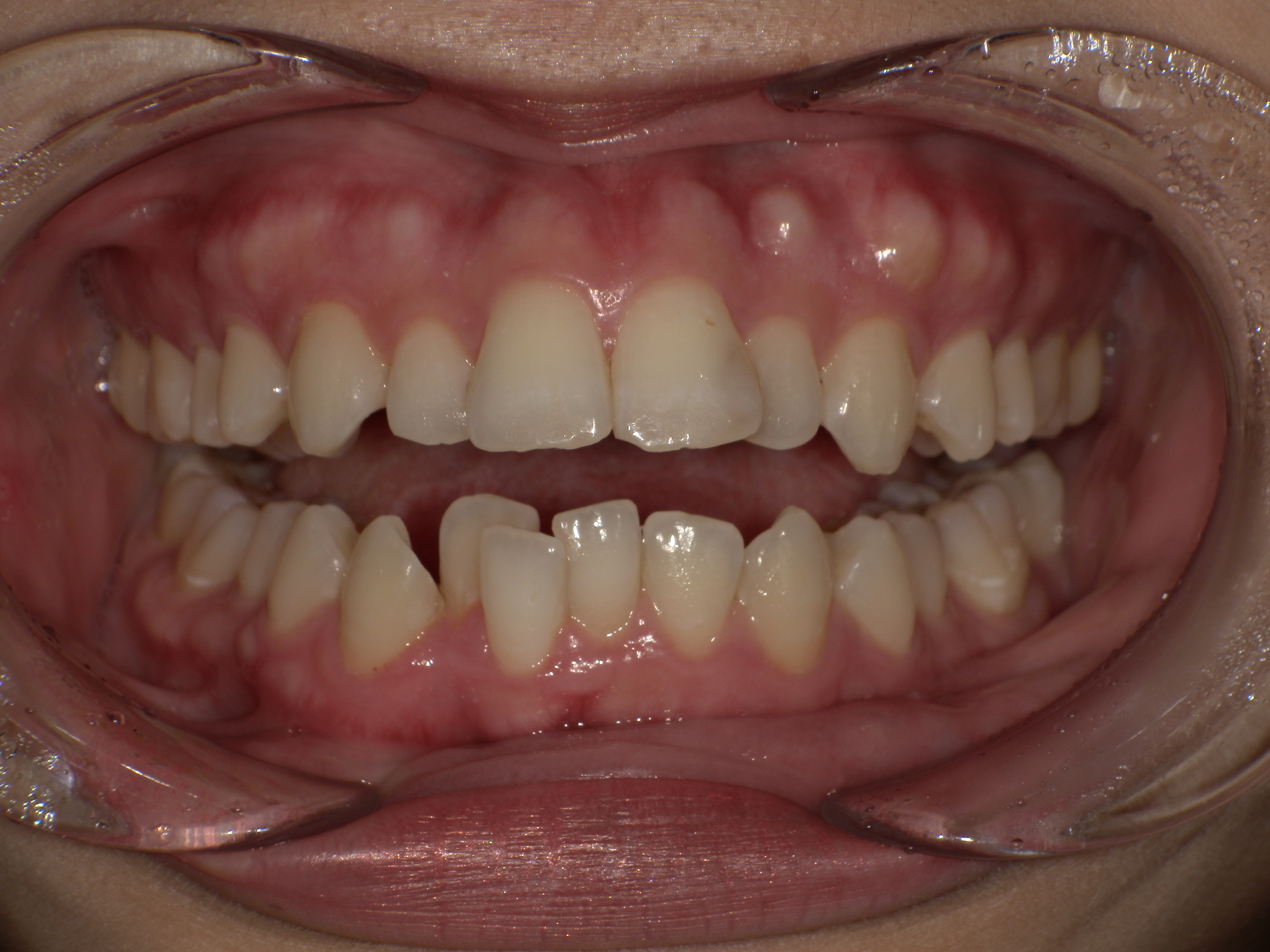 【治療前】歯並びがデコボコしている、上の歯が出ている(女性/20代)の口元