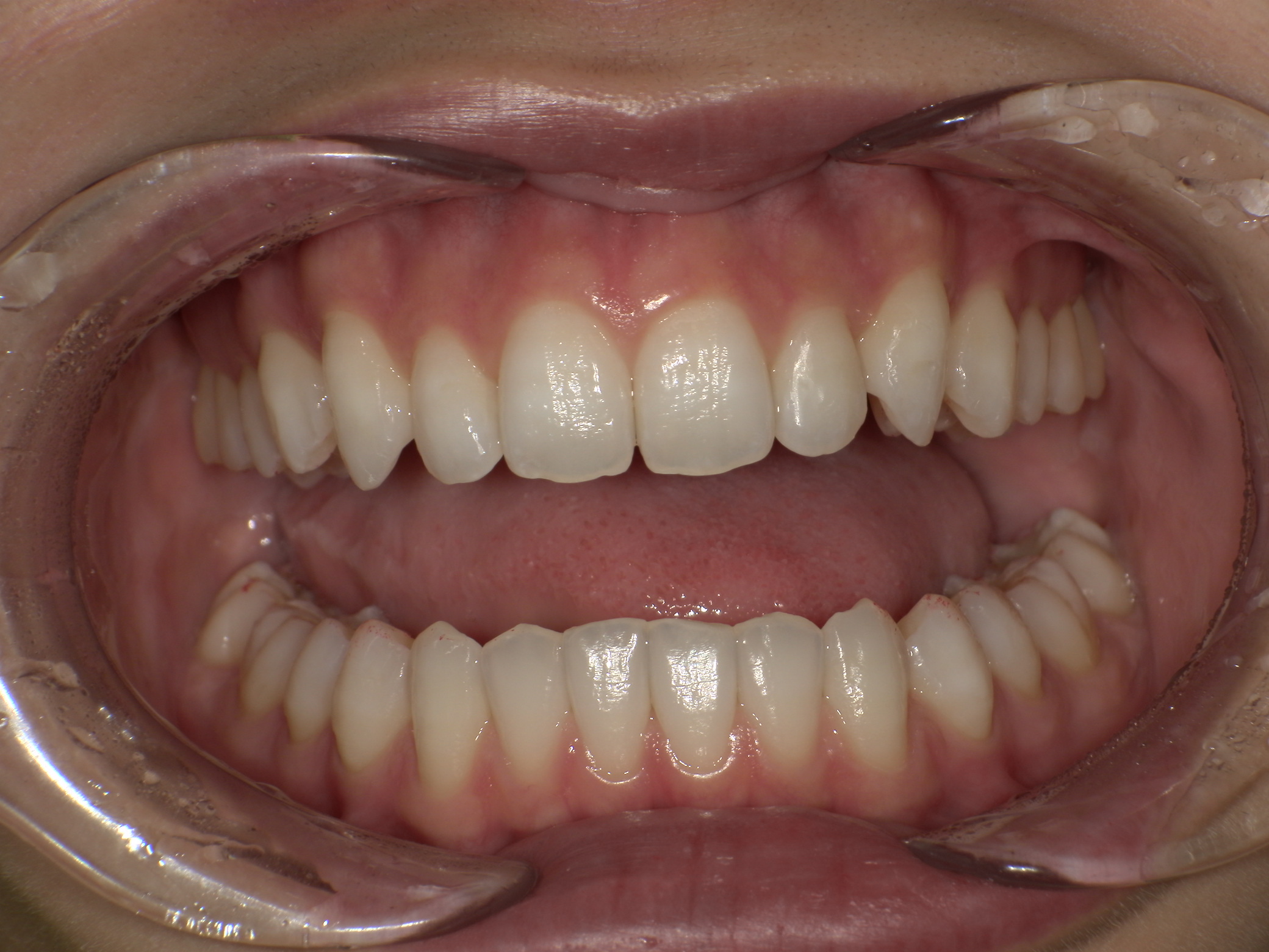 【治療後】すきっ歯が気になる・口元が出ているのが気になる・嚙み合わせが深い(女性/20代)の口元