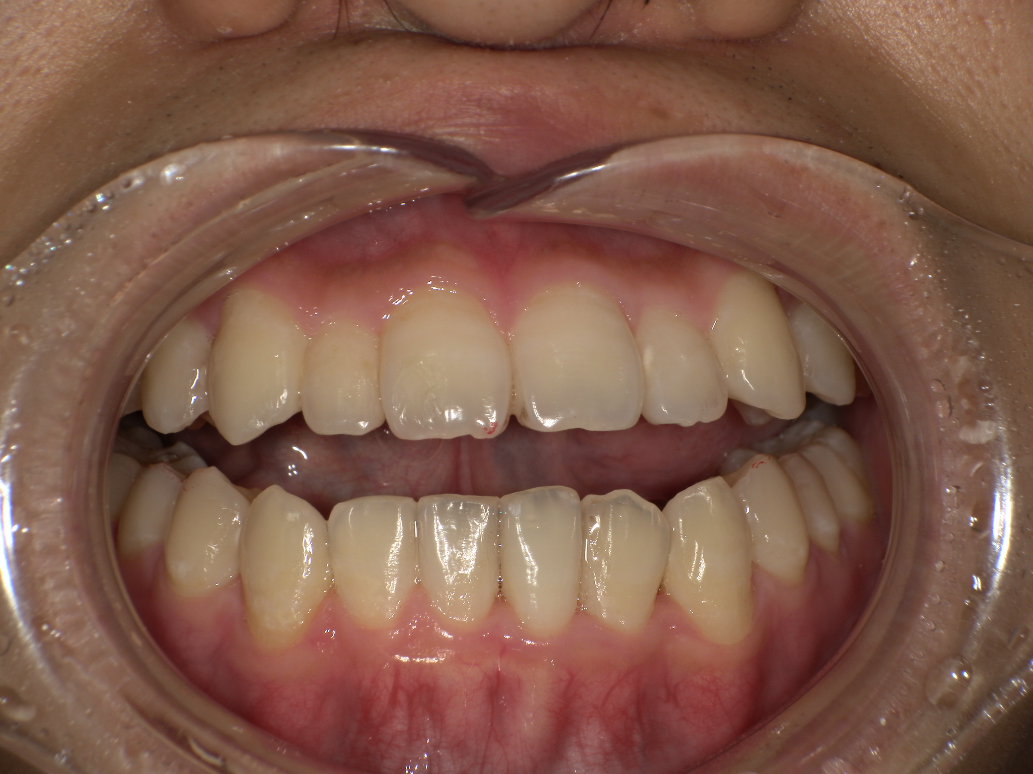 【治療後】歯並びがデコボコしている(男性/20代)の口元