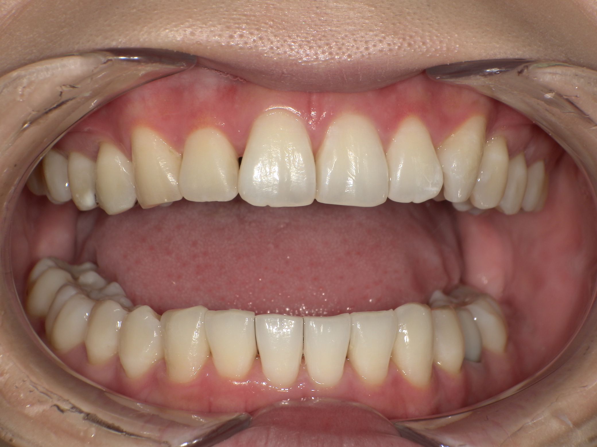 【治療後】前歯のガタガタが気になる(女性/20代)の口元