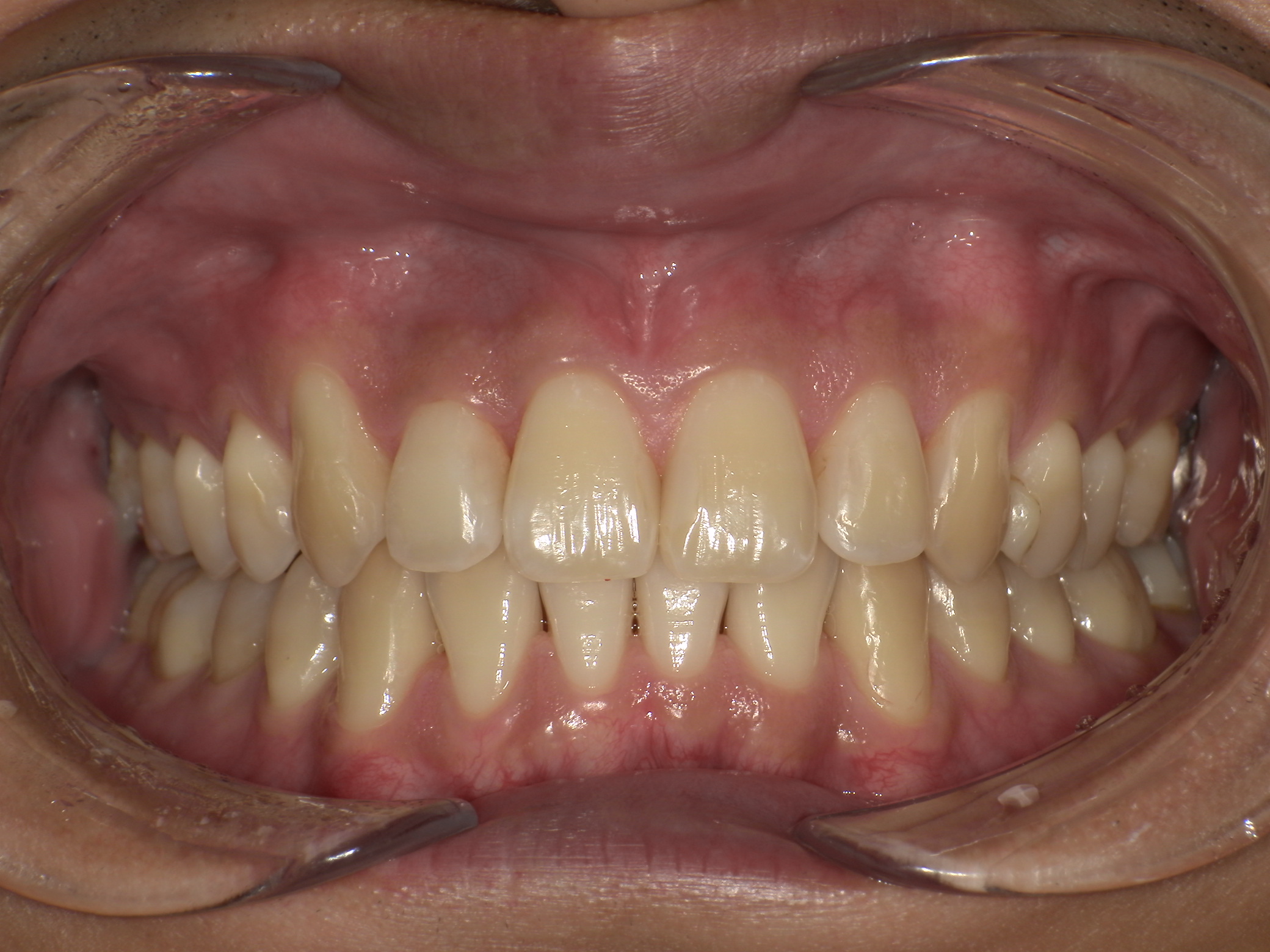 【治療後】歯並びがデコボコしている(男性/30代)の口元