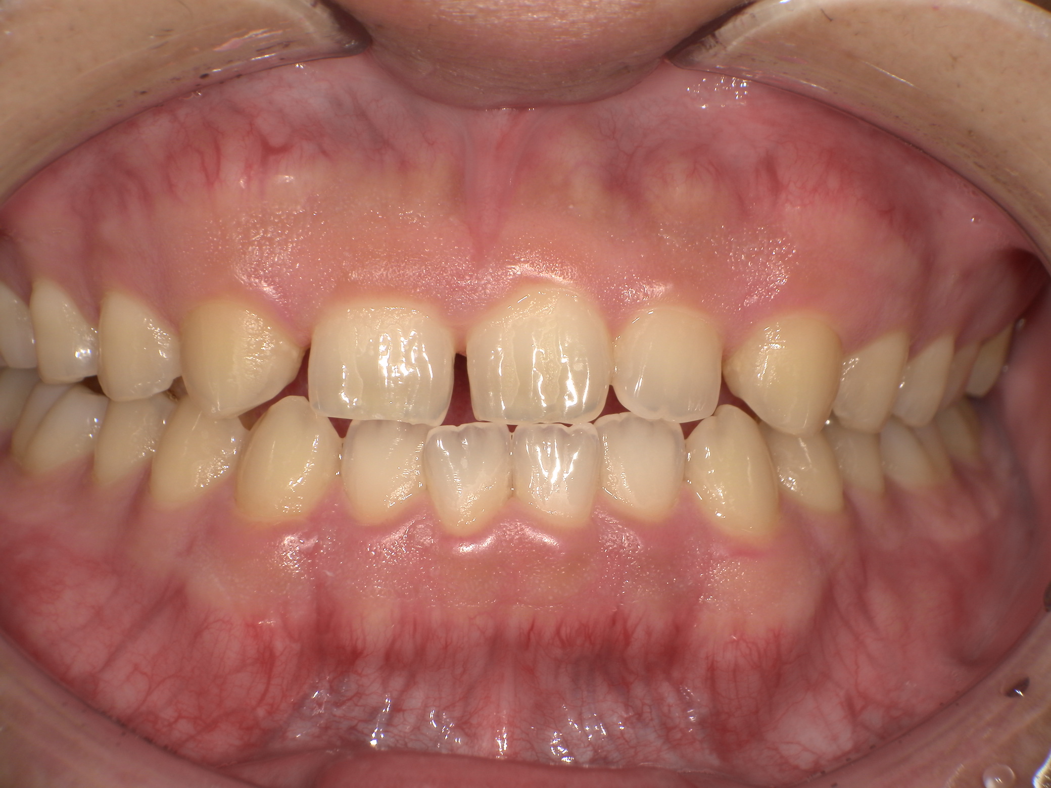 【治療前】すきっ歯が気になる(男性/20代)の口元