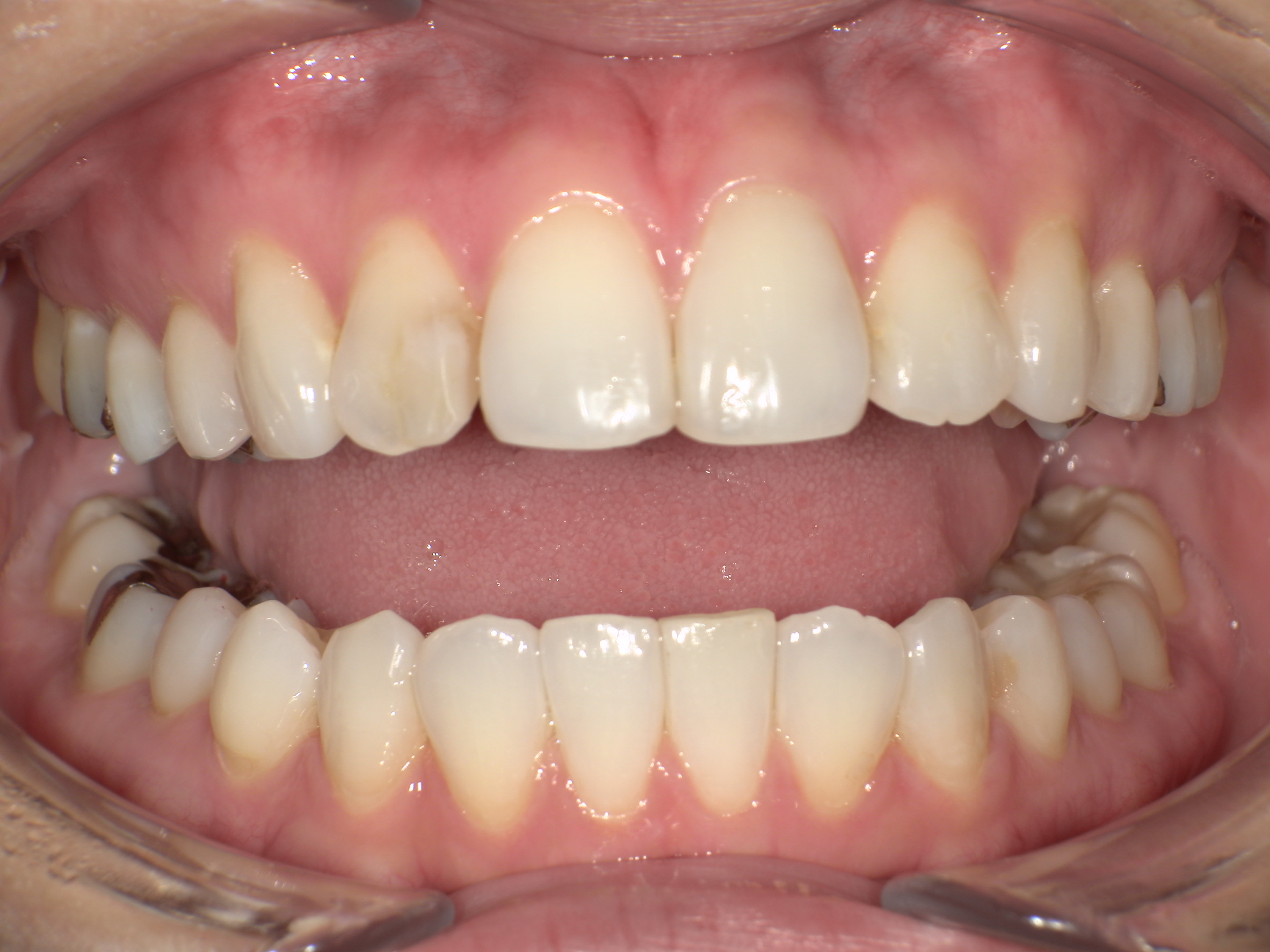 【治療後】上の歯が出ている・口元が出ているのが気になる(女性/30代)の口元