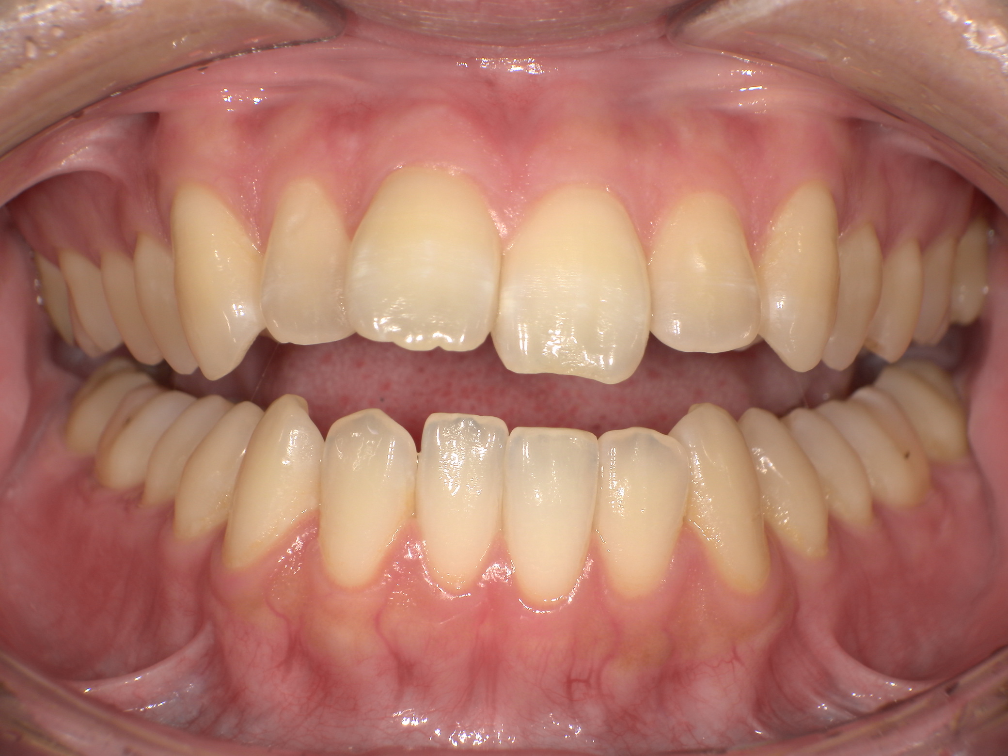 【治療前】口元が出ているのが気になる(女性/30代)の口元