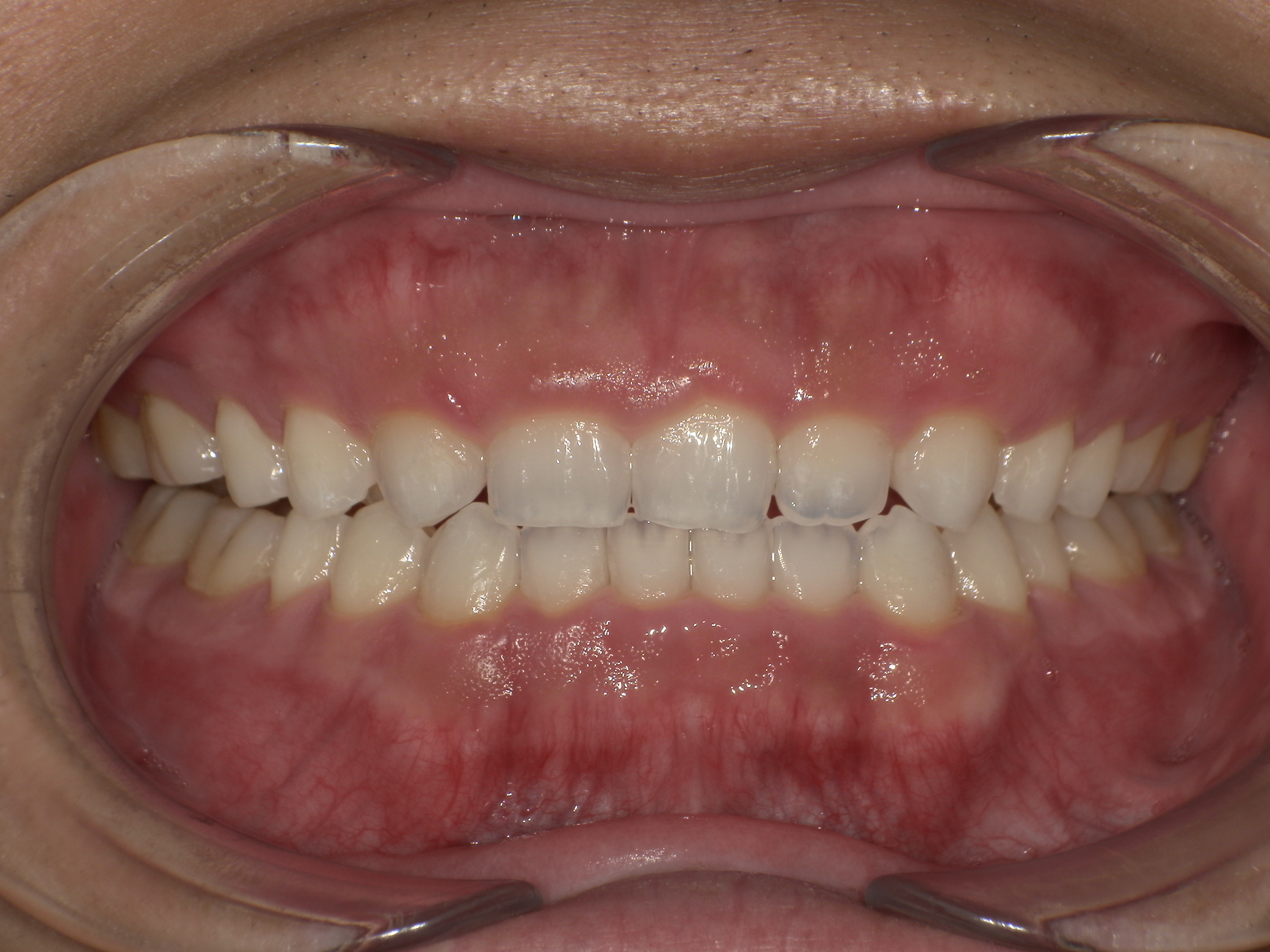 【治療後】すきっ歯が気になる(男性/20代)の口元