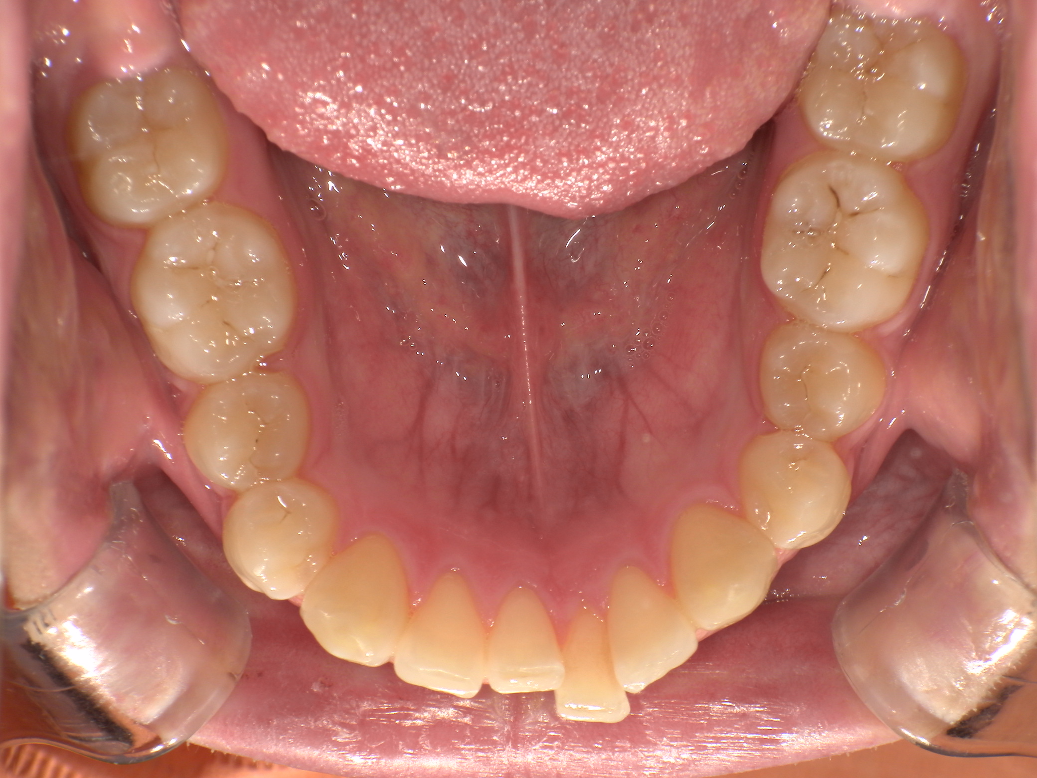 【治療前】下の歯のがたつきが気になる(男性/10代)の口元