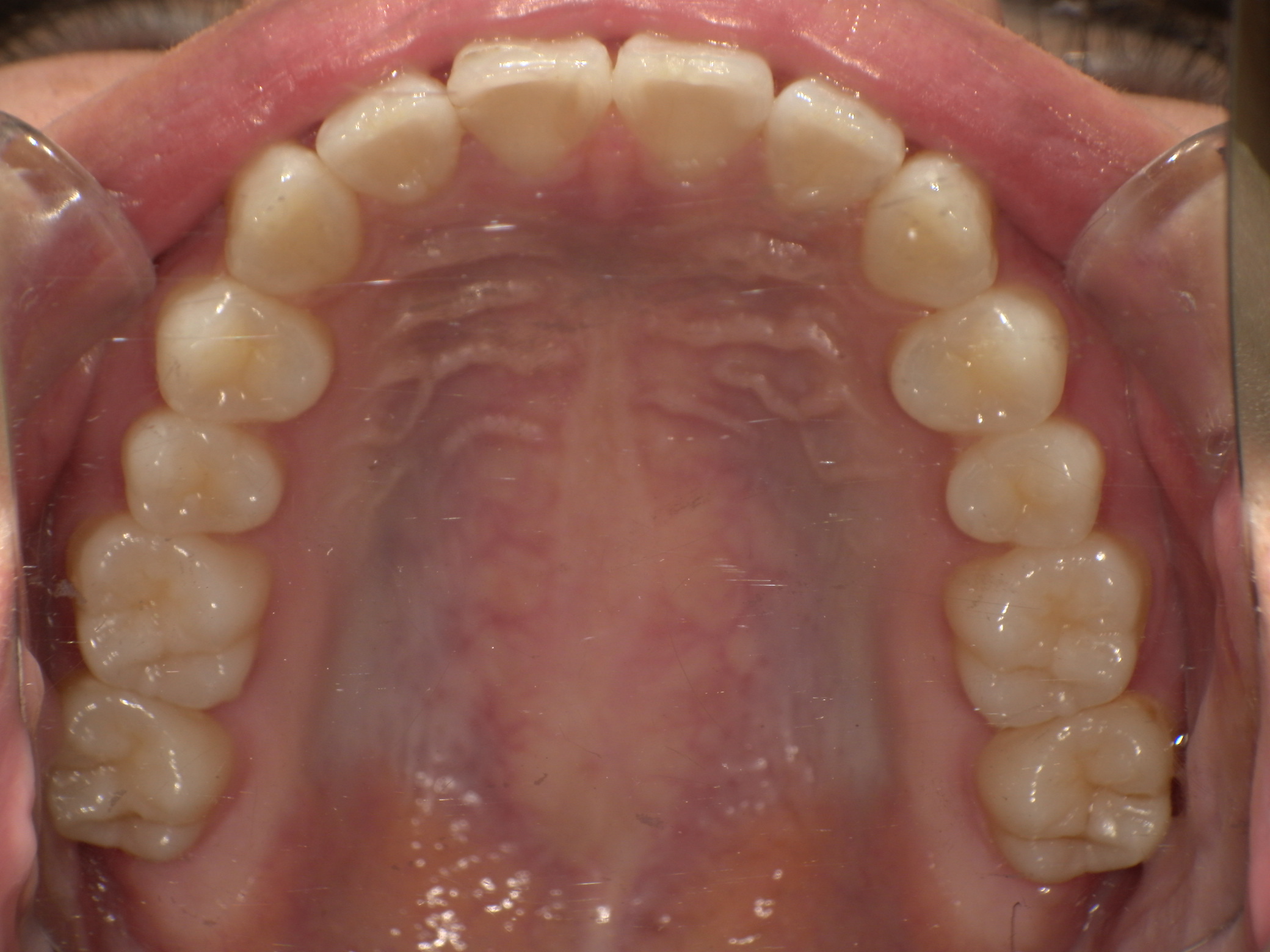 【治療後】上の歯が出ている(女性/20代)の口元