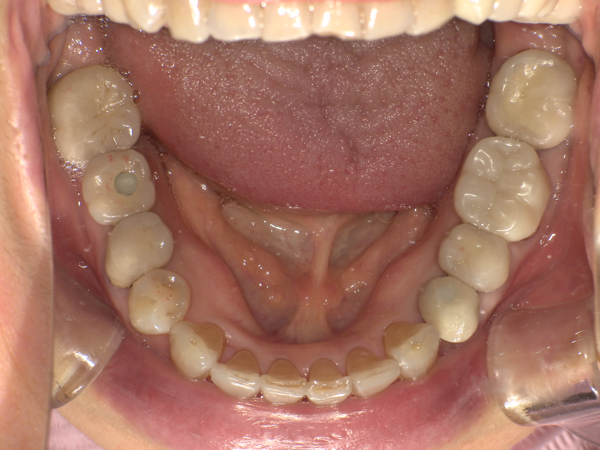 【治療後】前歯のガタガタが気になる(女性/50代)の口元
