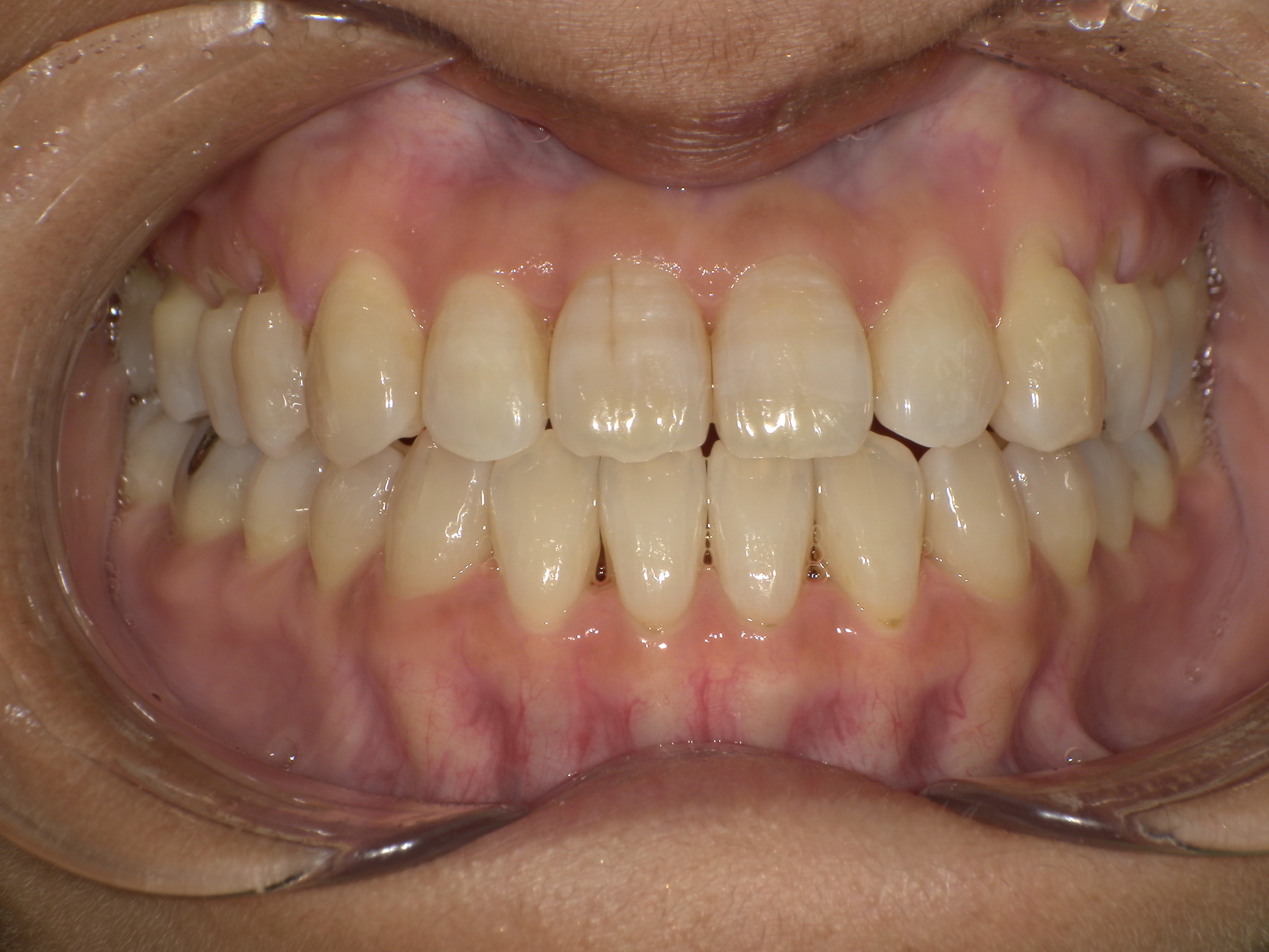 【治療後】歯並びがデコボコしている(女性/40代)の口元