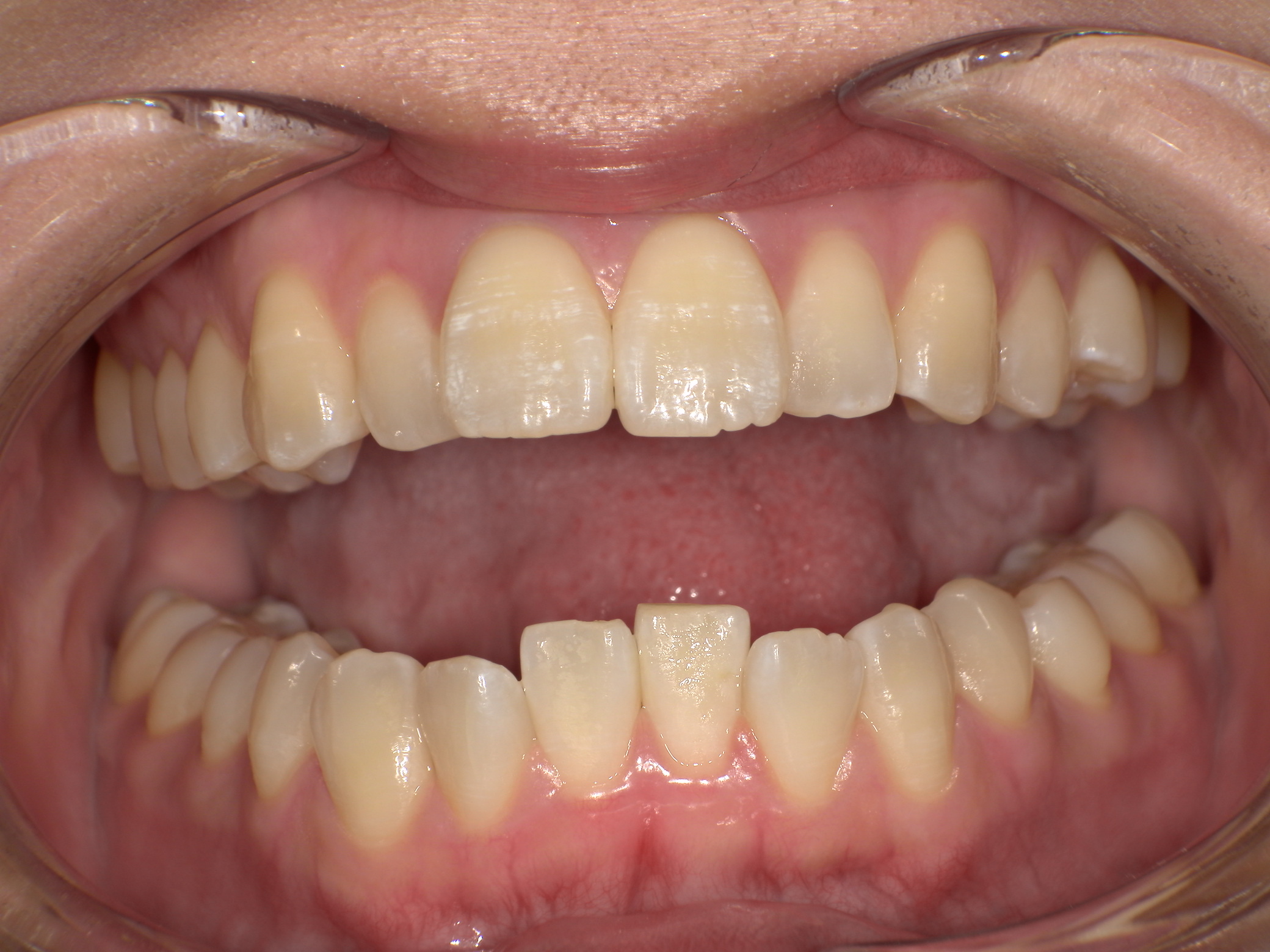 【治療前】歯並びがデコボコしている(女性/20代)の口元