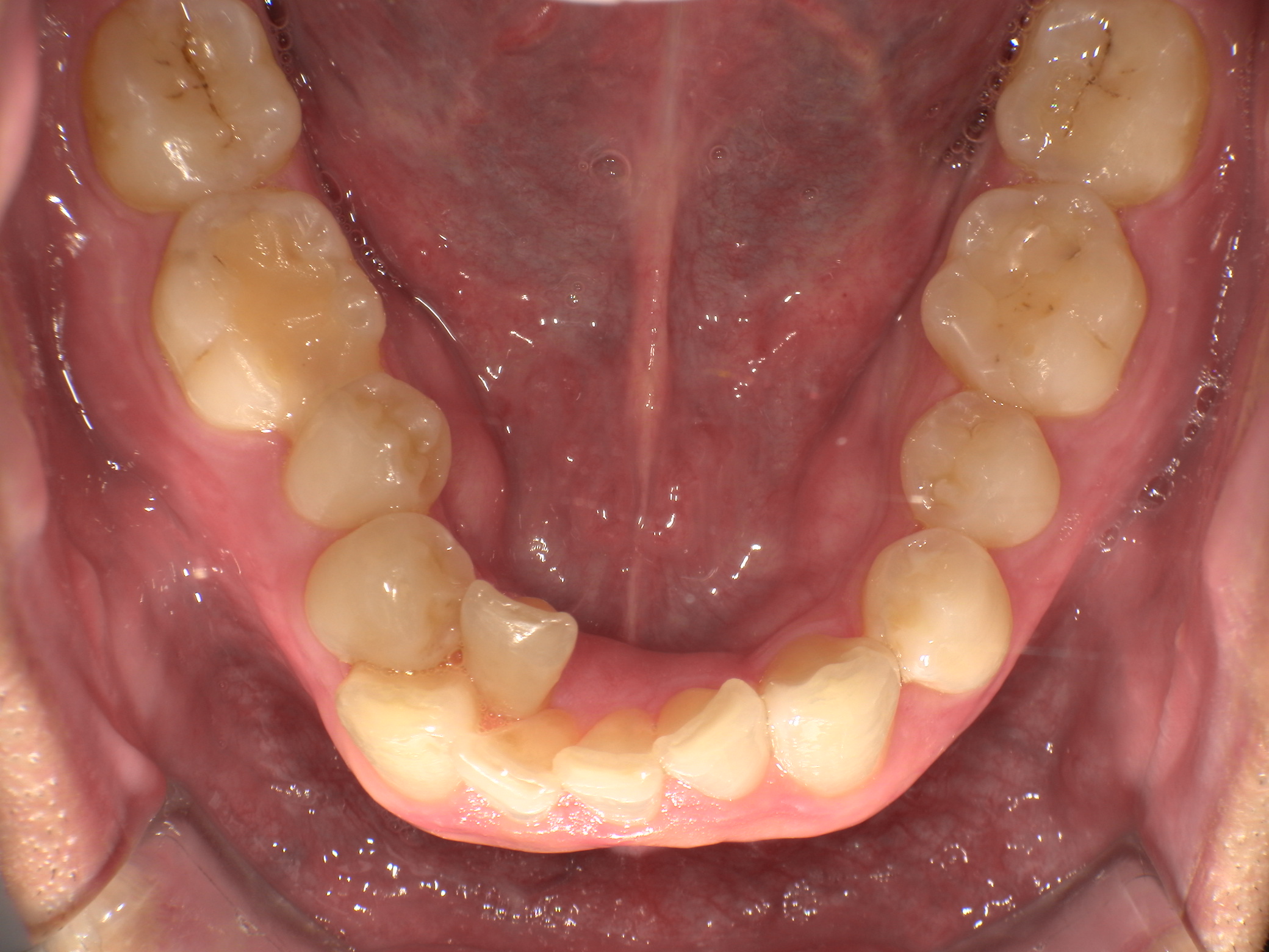 【治療前】歯並びがデコボコしている(男性/30代)の口元