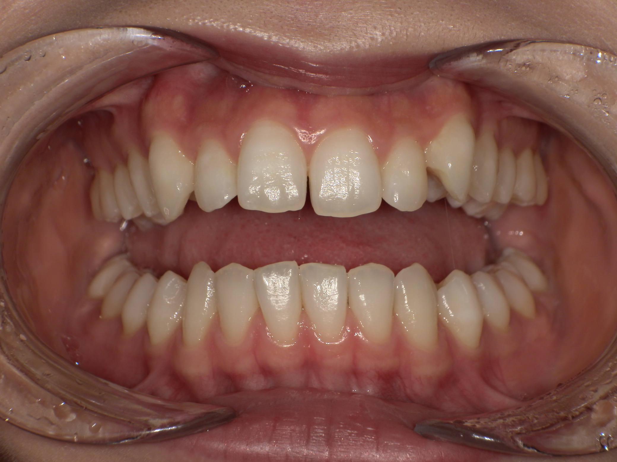 【治療前】すきっ歯が気になる・口元が出ているのが気になる・嚙み合わせが深い(女性/20代)の口元