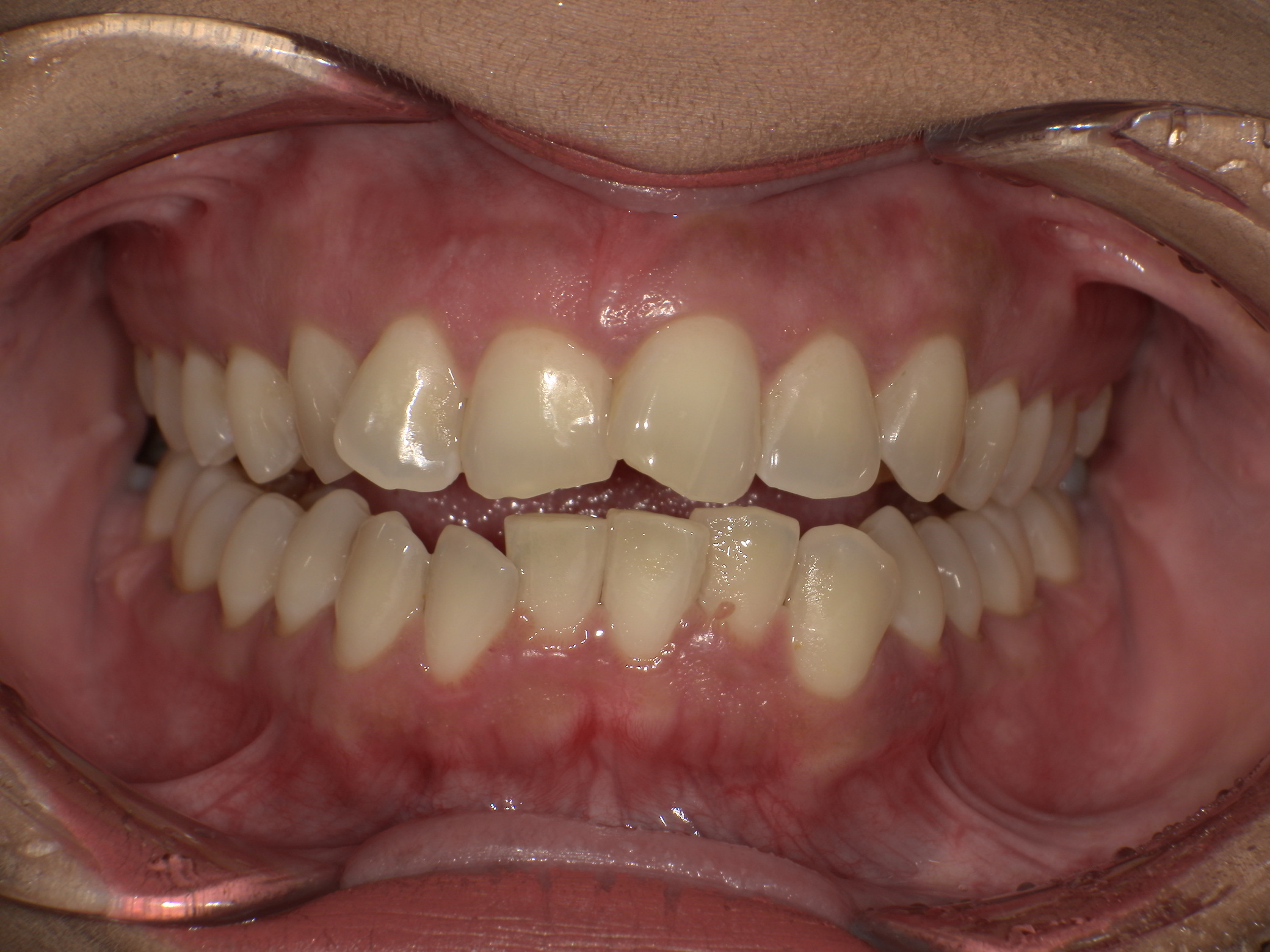 【治療前】前歯のがたつきが気になる(女性/30代)の口元